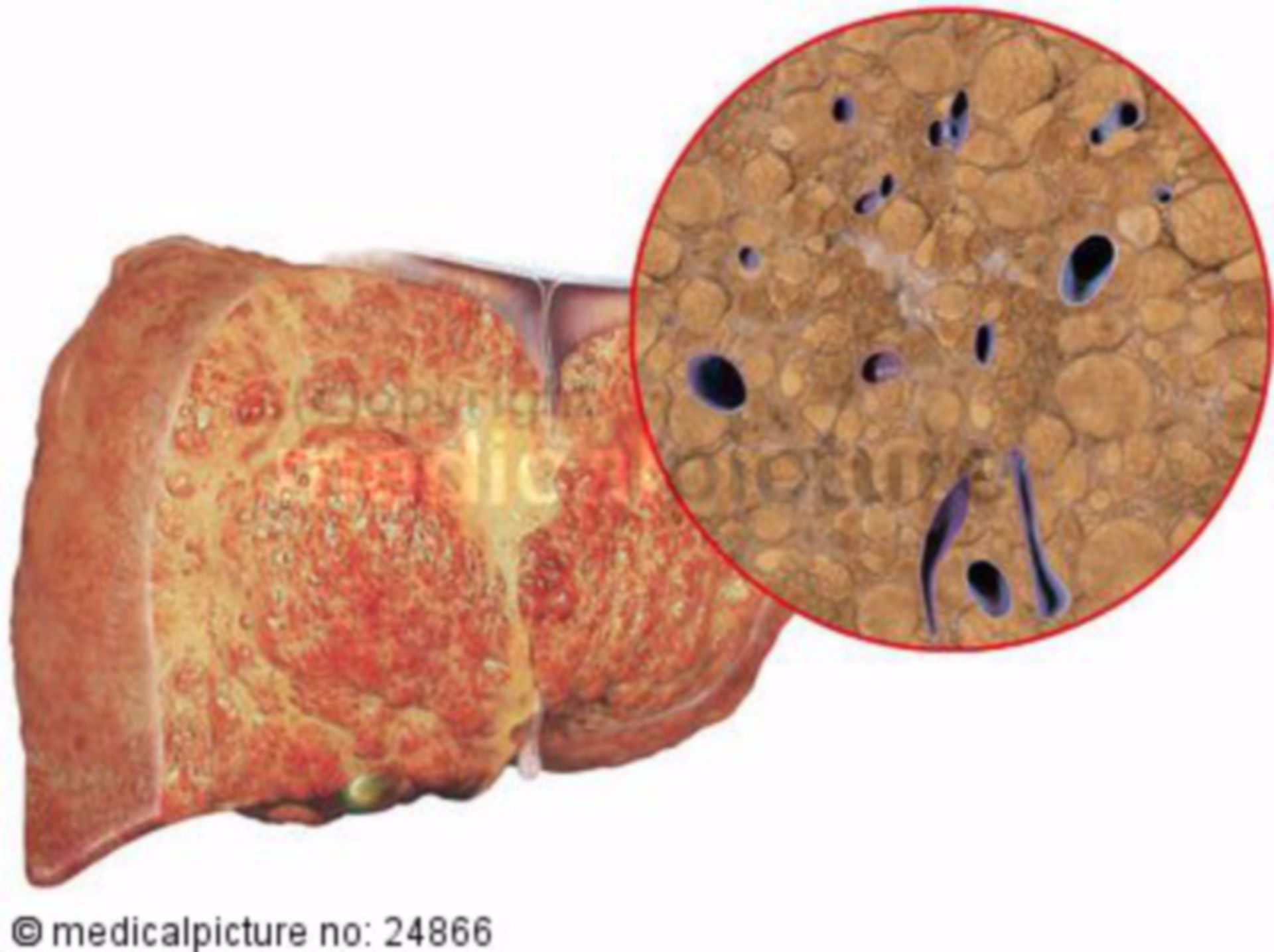 Liver cirrhosis, organ and histology