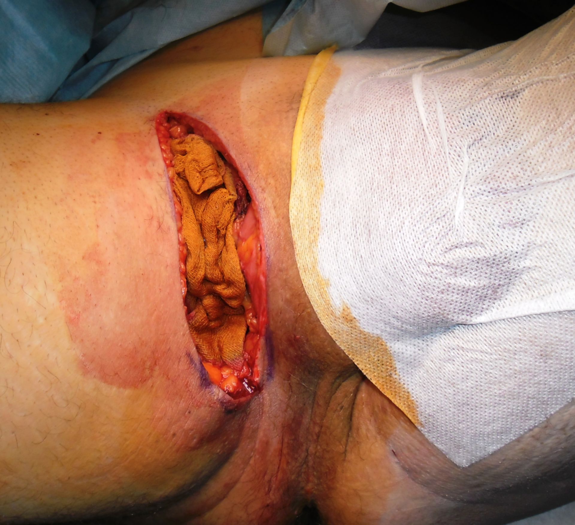 Acne inversa, right groin - open wound treatment