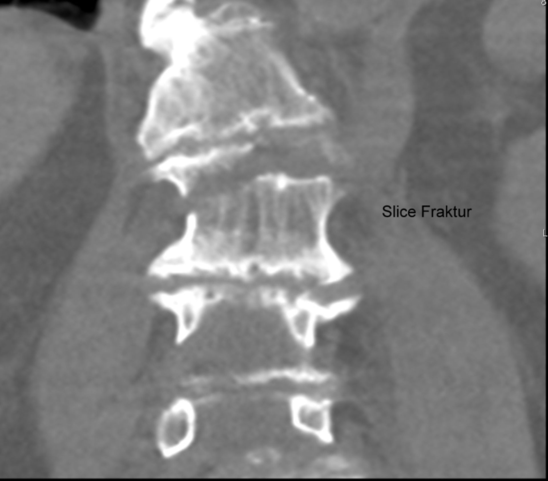 Vertebral fracture- Slice fracture