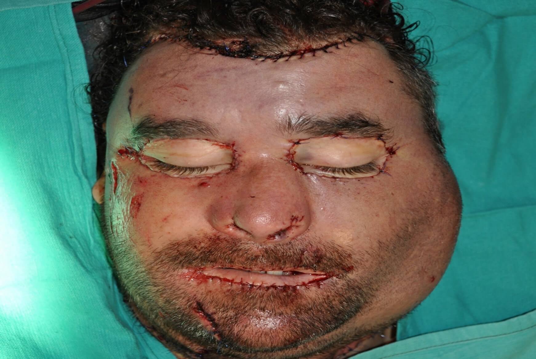 3-ankara_turkey_postoperative_original.jpg