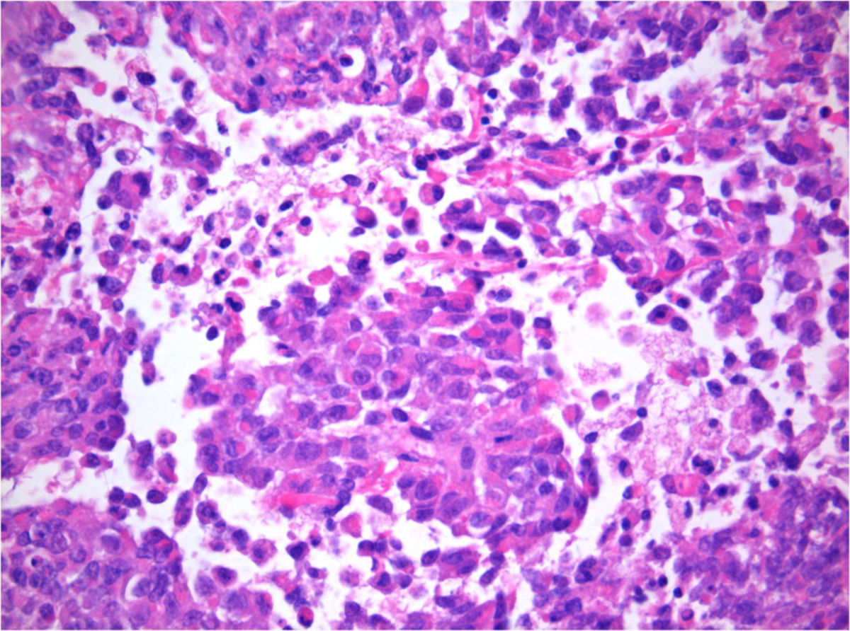 Atypischer teratoider/rhabdoider Tumor (Histopathologie)