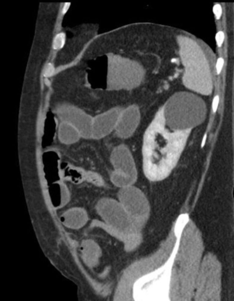 CT Abdomen Nierenzyste DocCheck