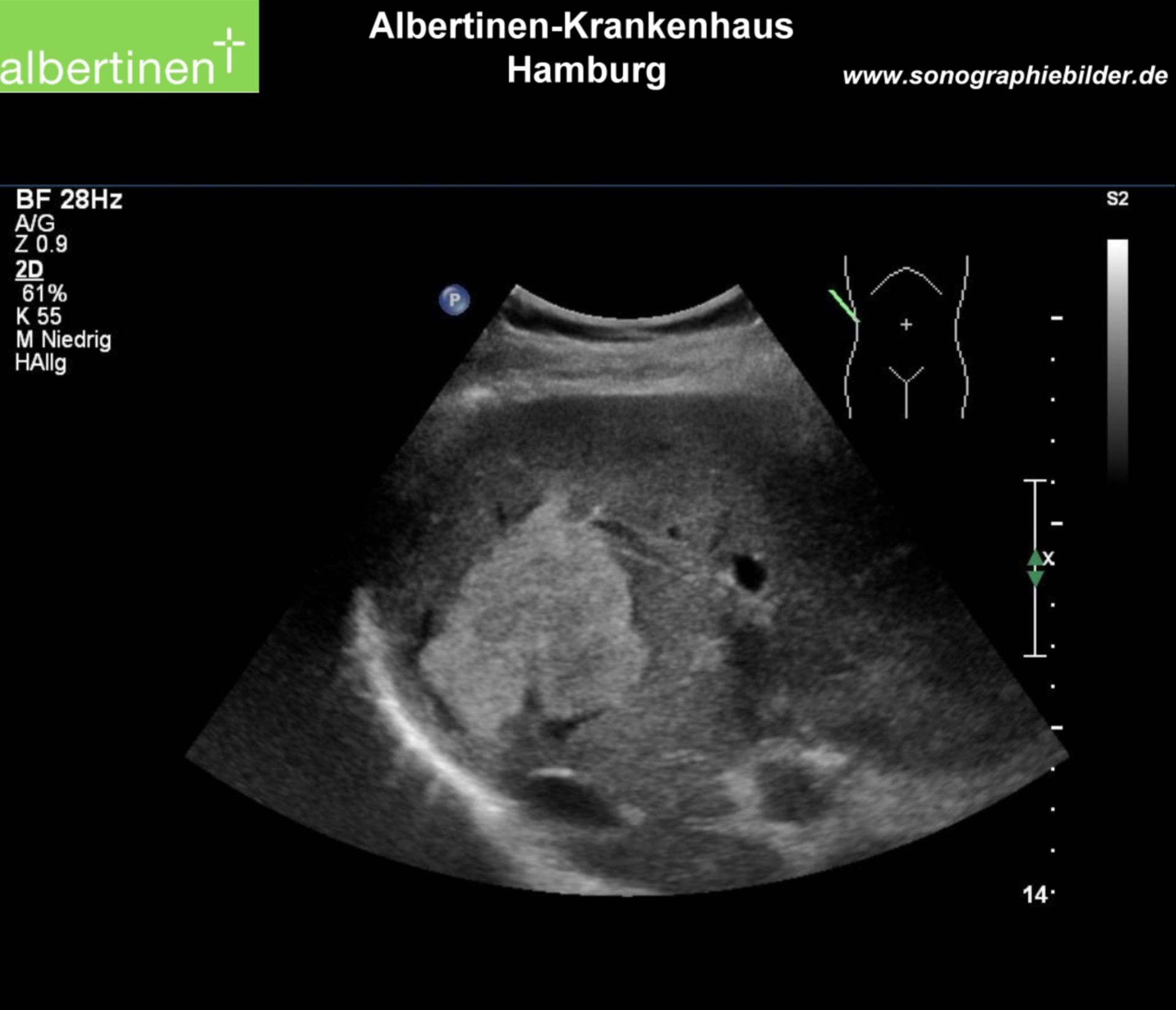 Ultrasonography: Landscape-like hemangioma