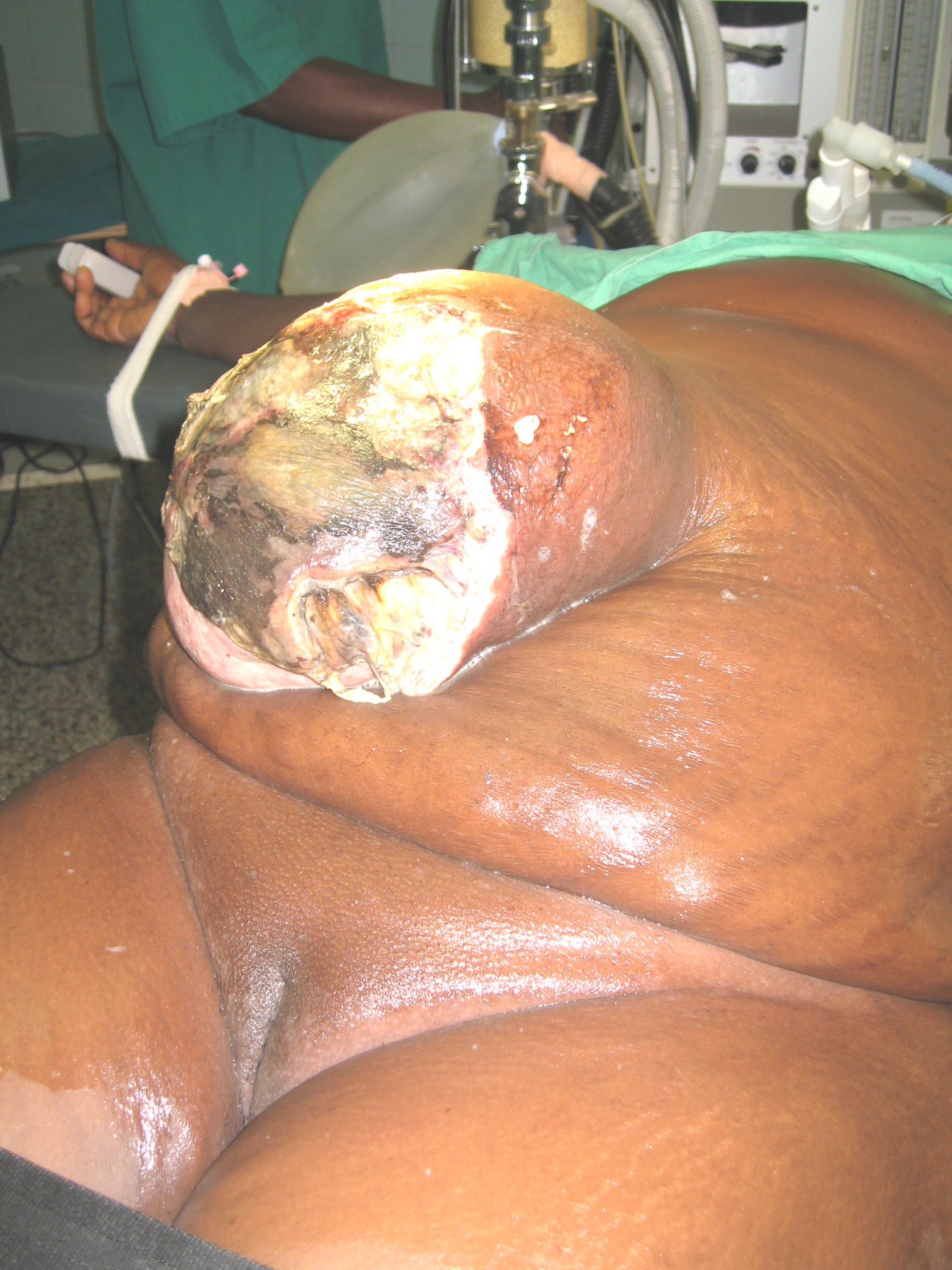Female patient during surgery in Akwatia, Ghana