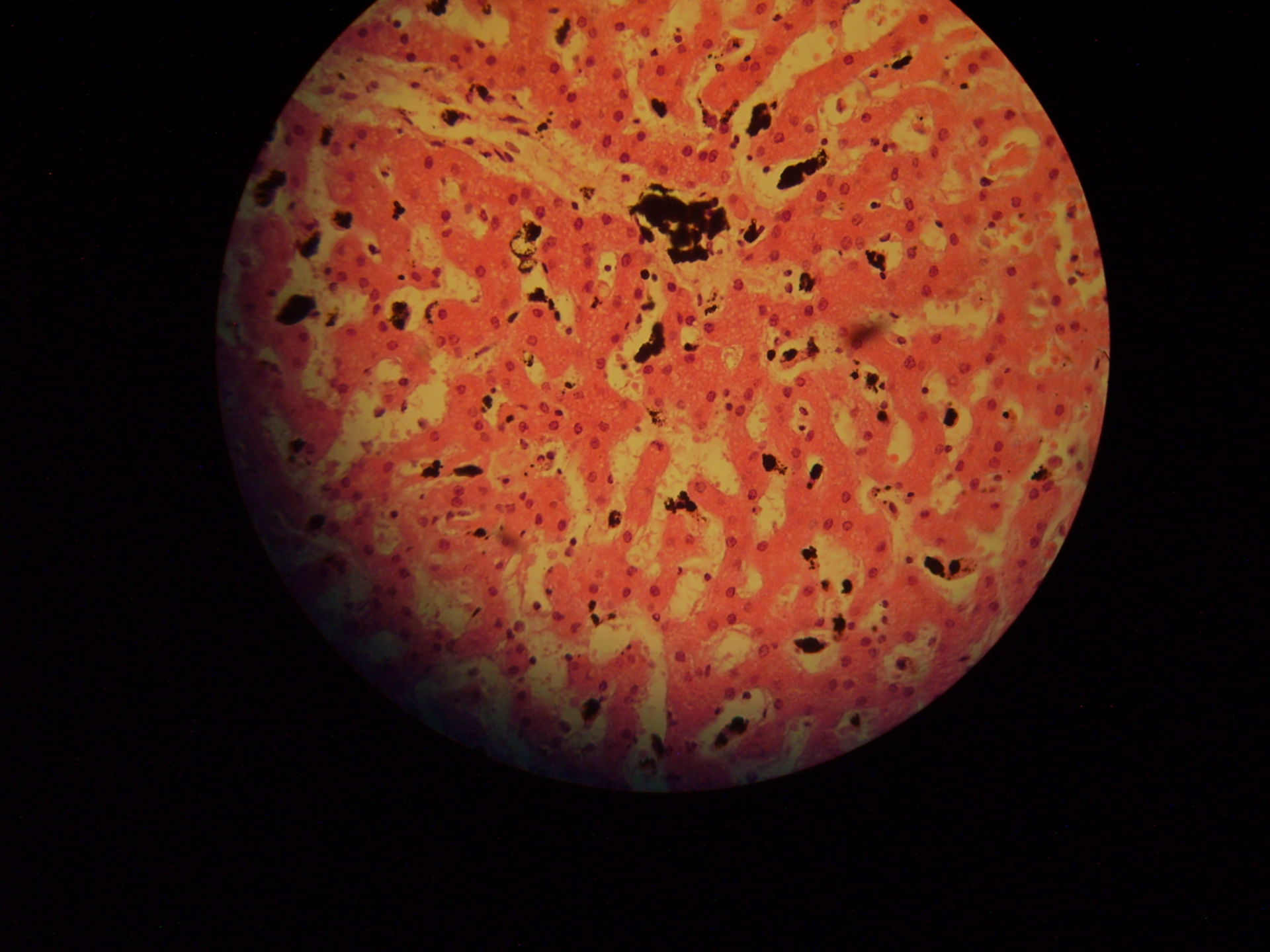 Malaria der Leber Schizonten