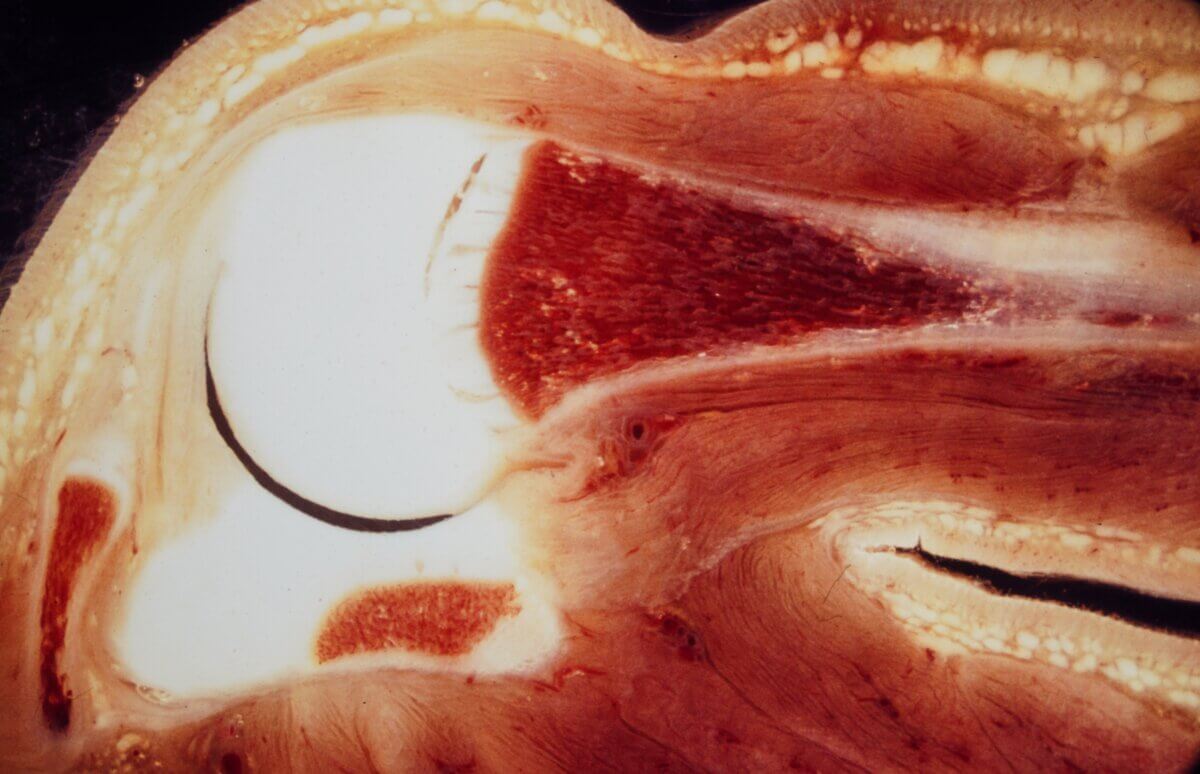 Frontalschnitt Caput humeri