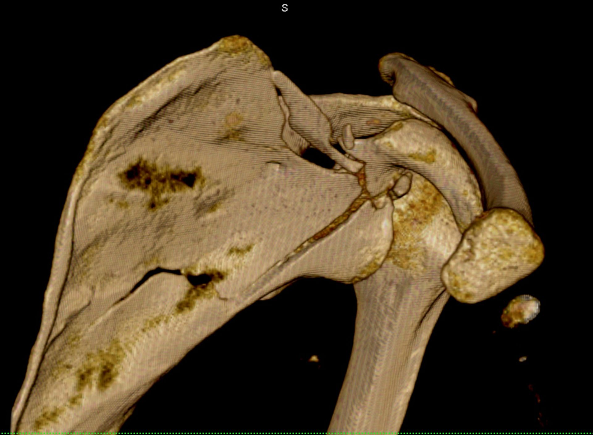 3D-Rekonstruktion einer CT der Schulter mit Scapulafraktur