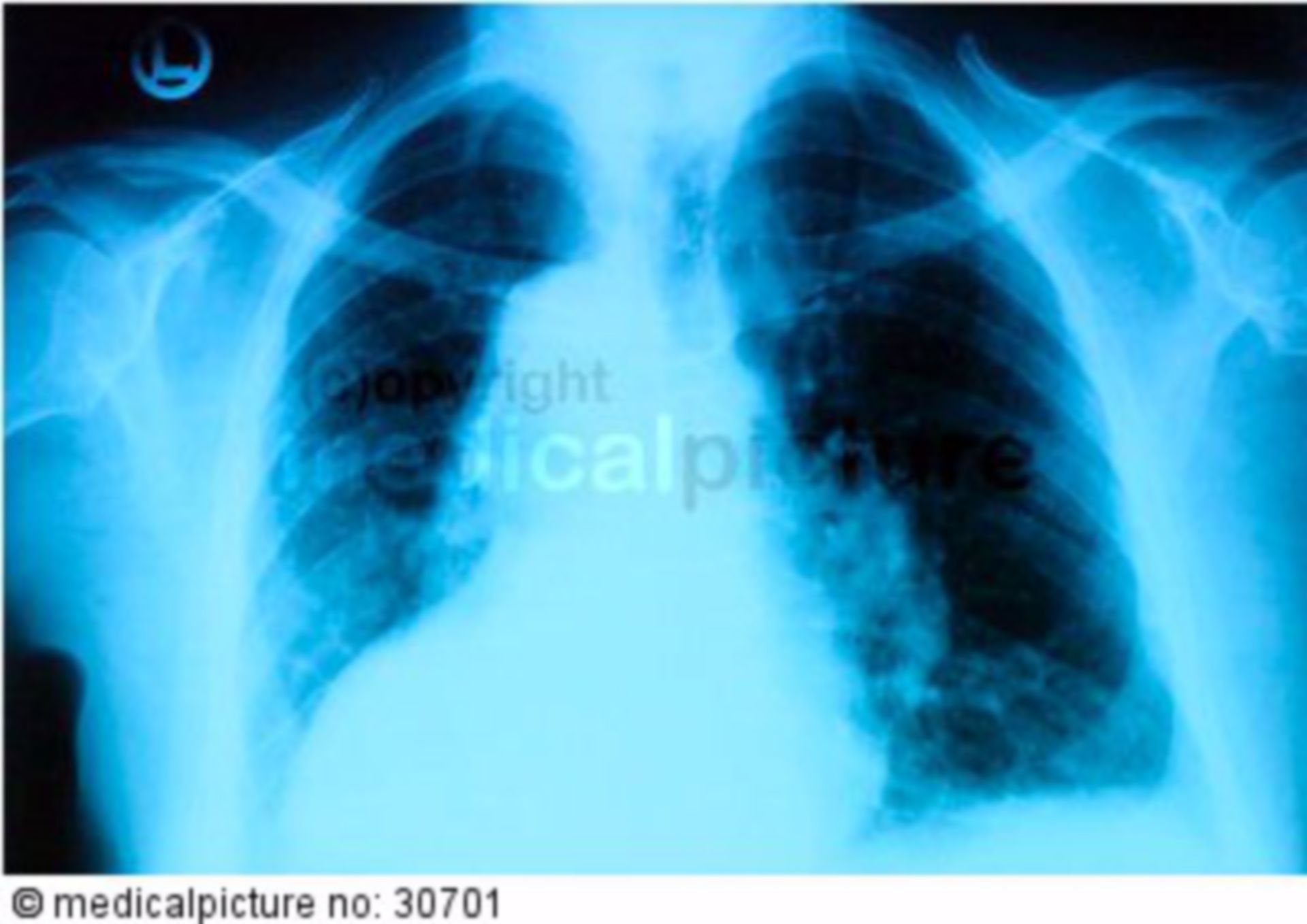 Röntgenbild vom Brustkorb