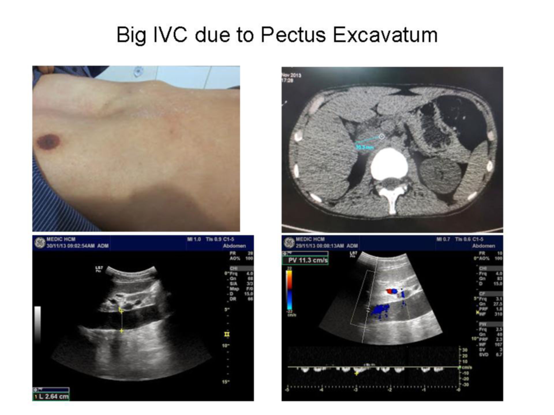 Big IVC due to Pectus Excavatum