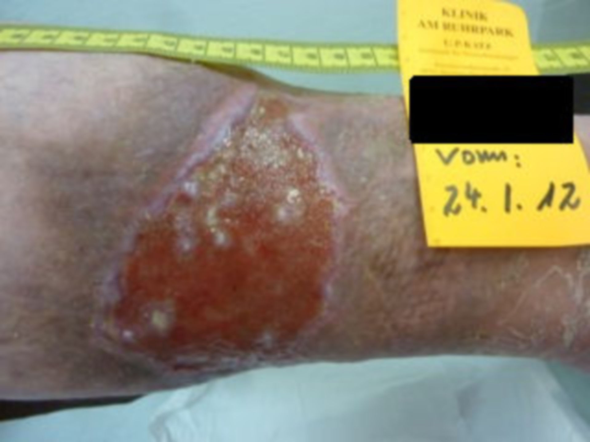 7 years open (26) - healing process