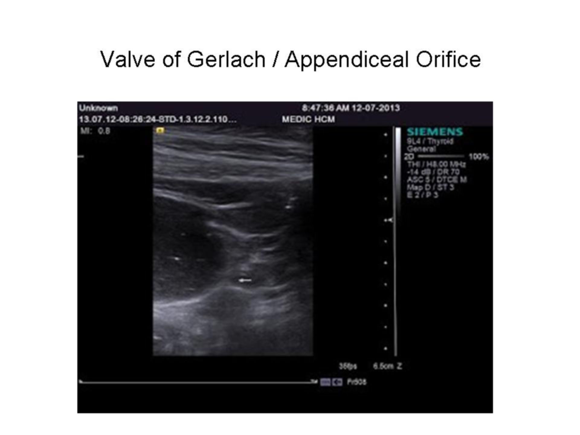 Appendiceal orifice on Ultrasound