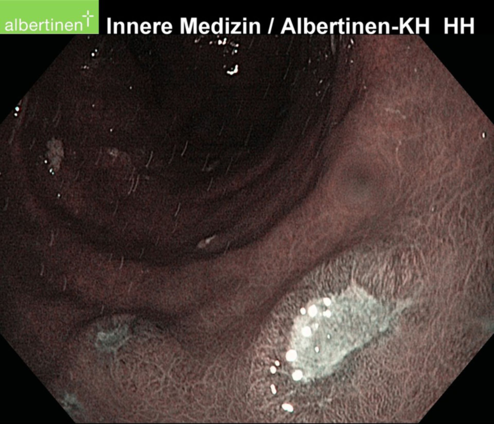 Papulous Gastritis