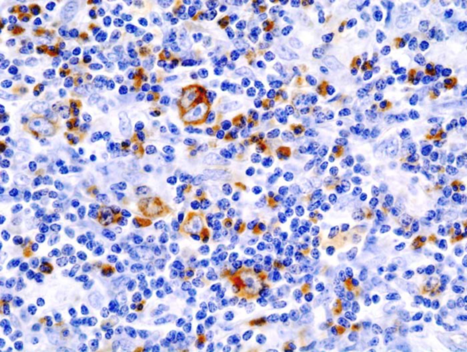 Hodgkin Lymphom (immunhistochemische Färbung, CD30)