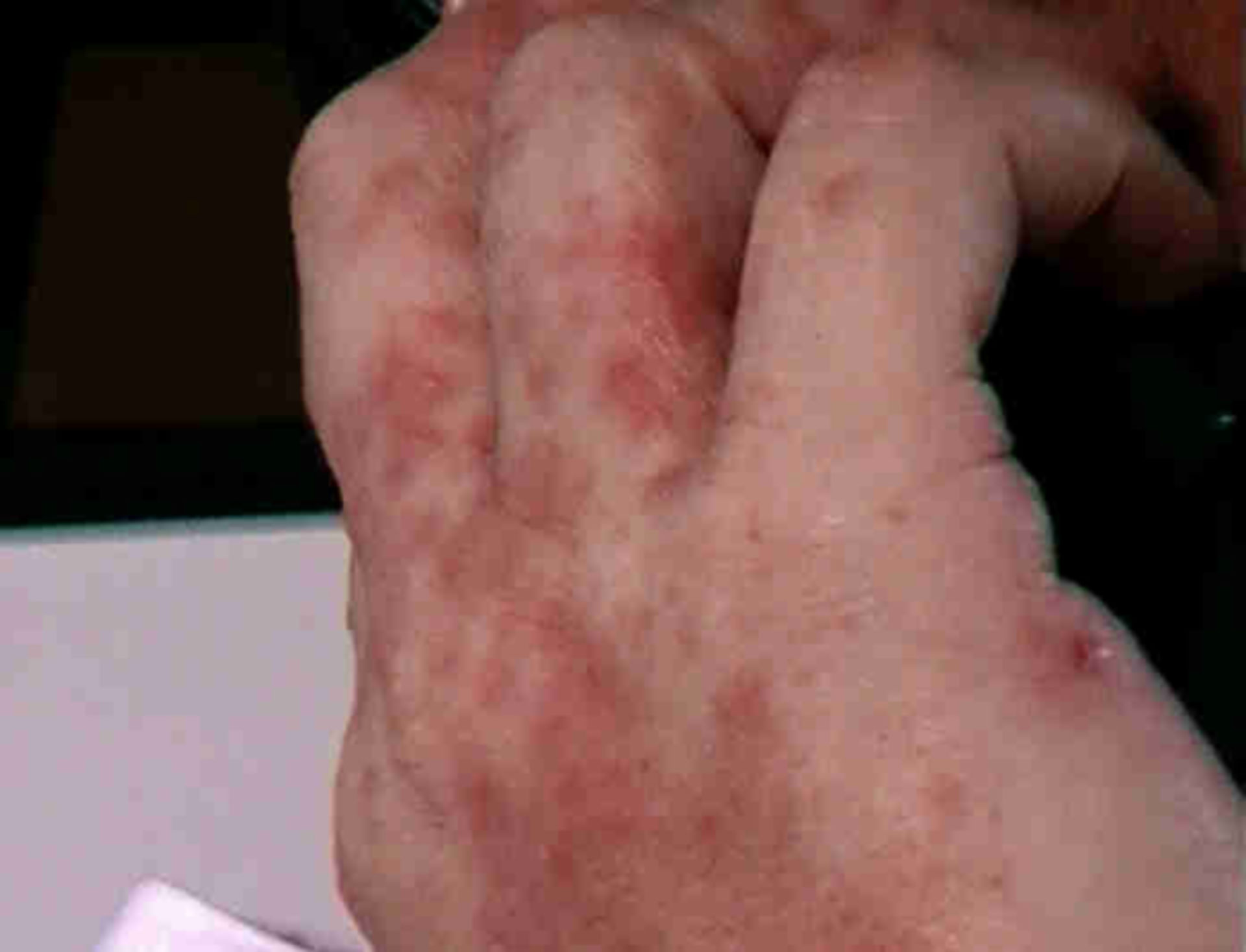 Neurodermitis der Finger