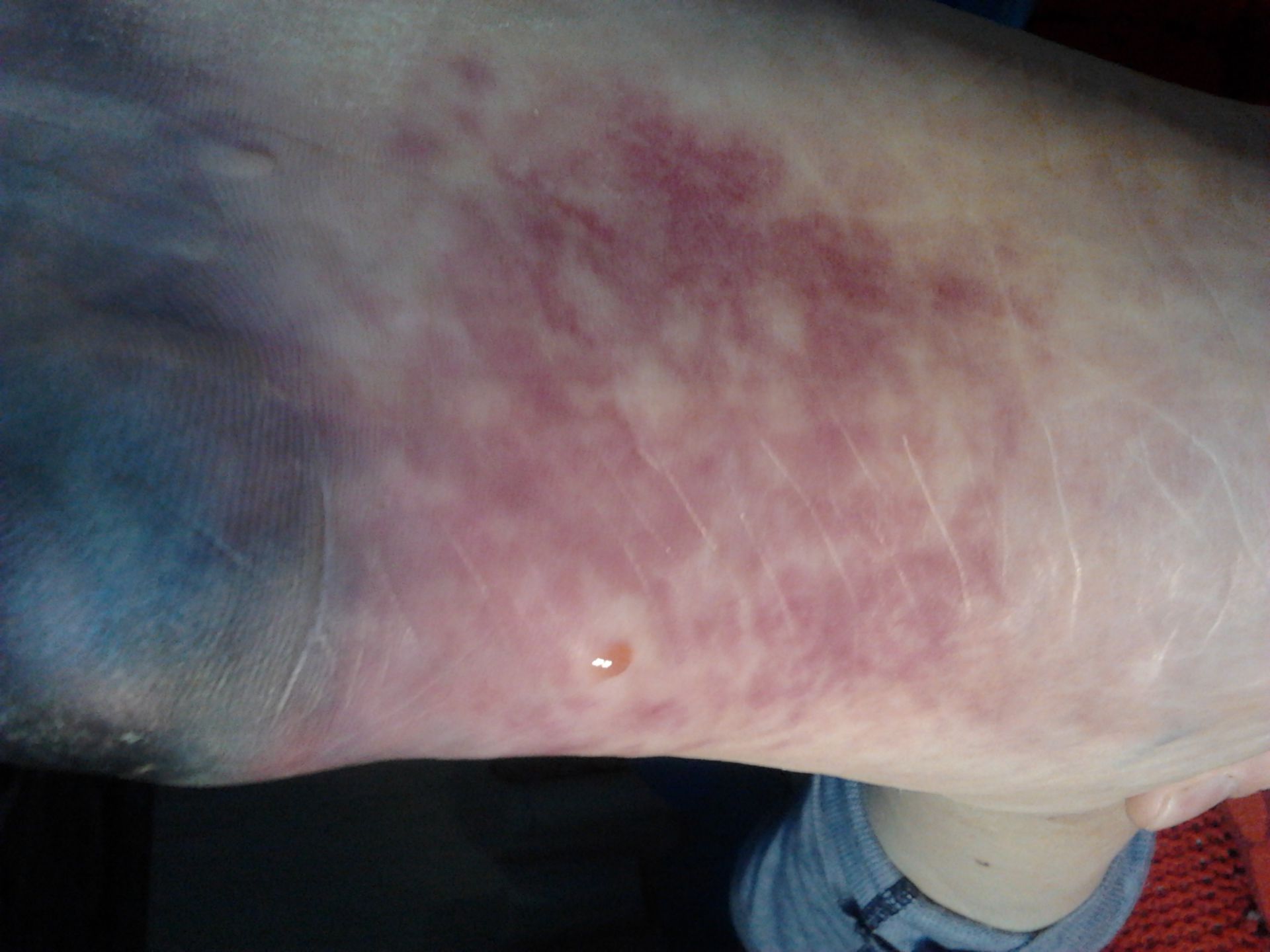 Peripheral vascular disease 30.01.2012