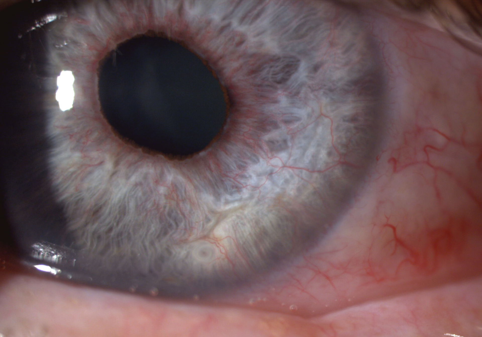 Rubeosis iridis mit Pupillenentrundung