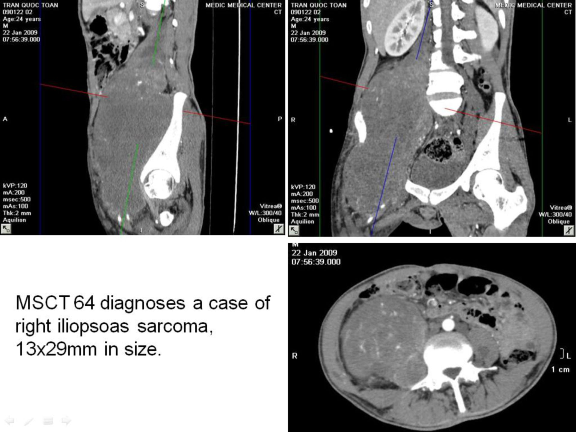 MPNST IN ileopsoas Muscolo / Neurofibromatosi di tipo 1