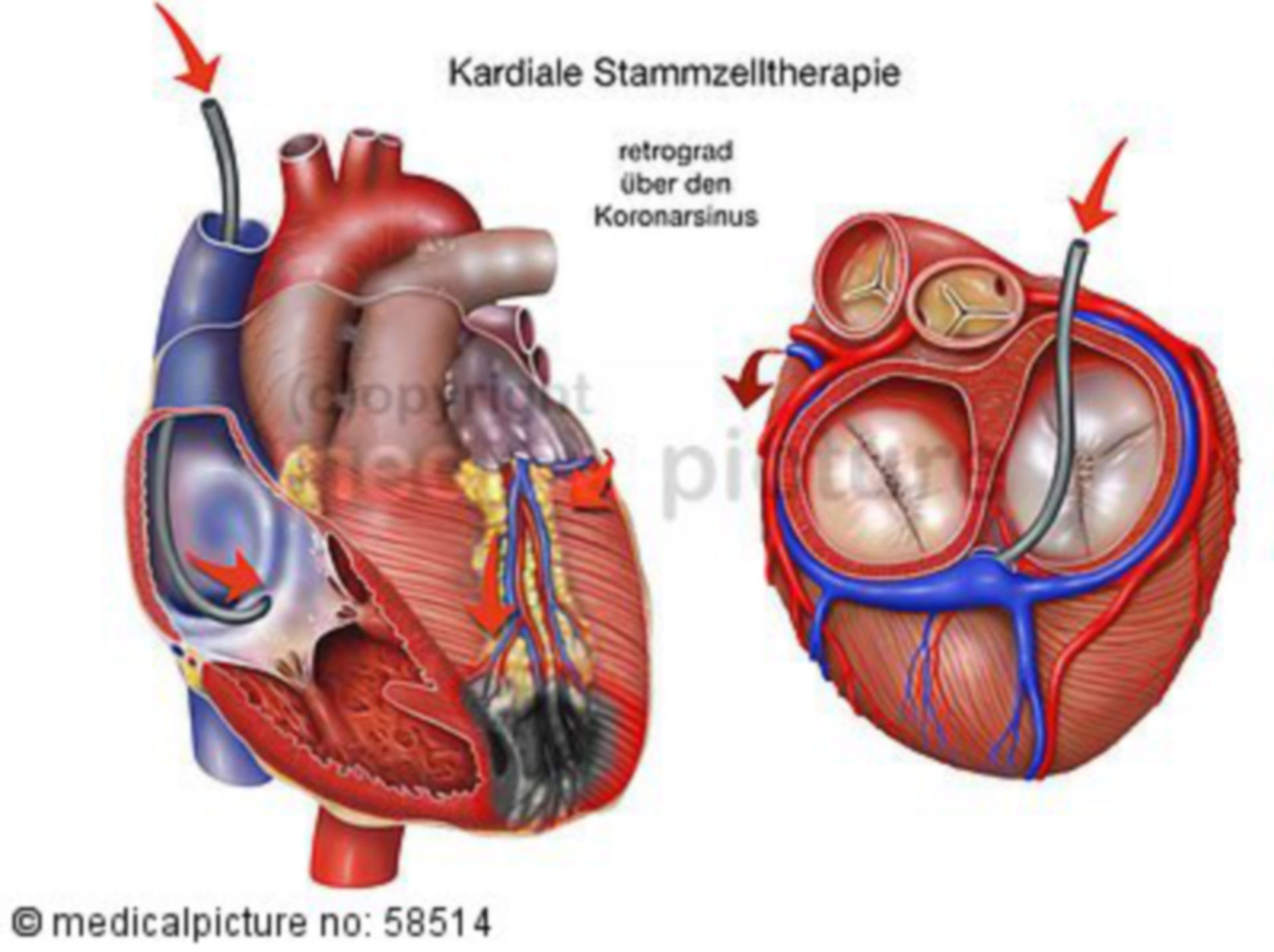 Cardiac stem cell therapy