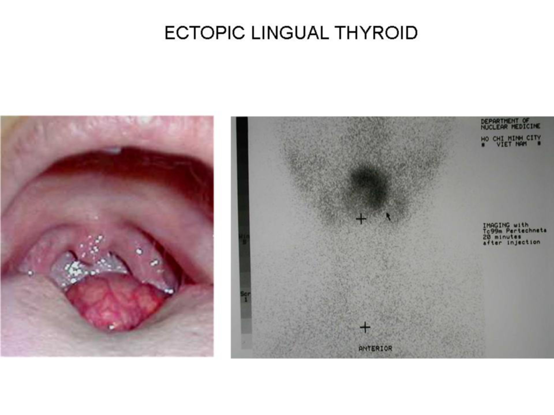 Tiroide linguale ectopica