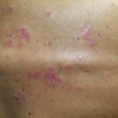 Effloreszenz DocCheck Flexikon