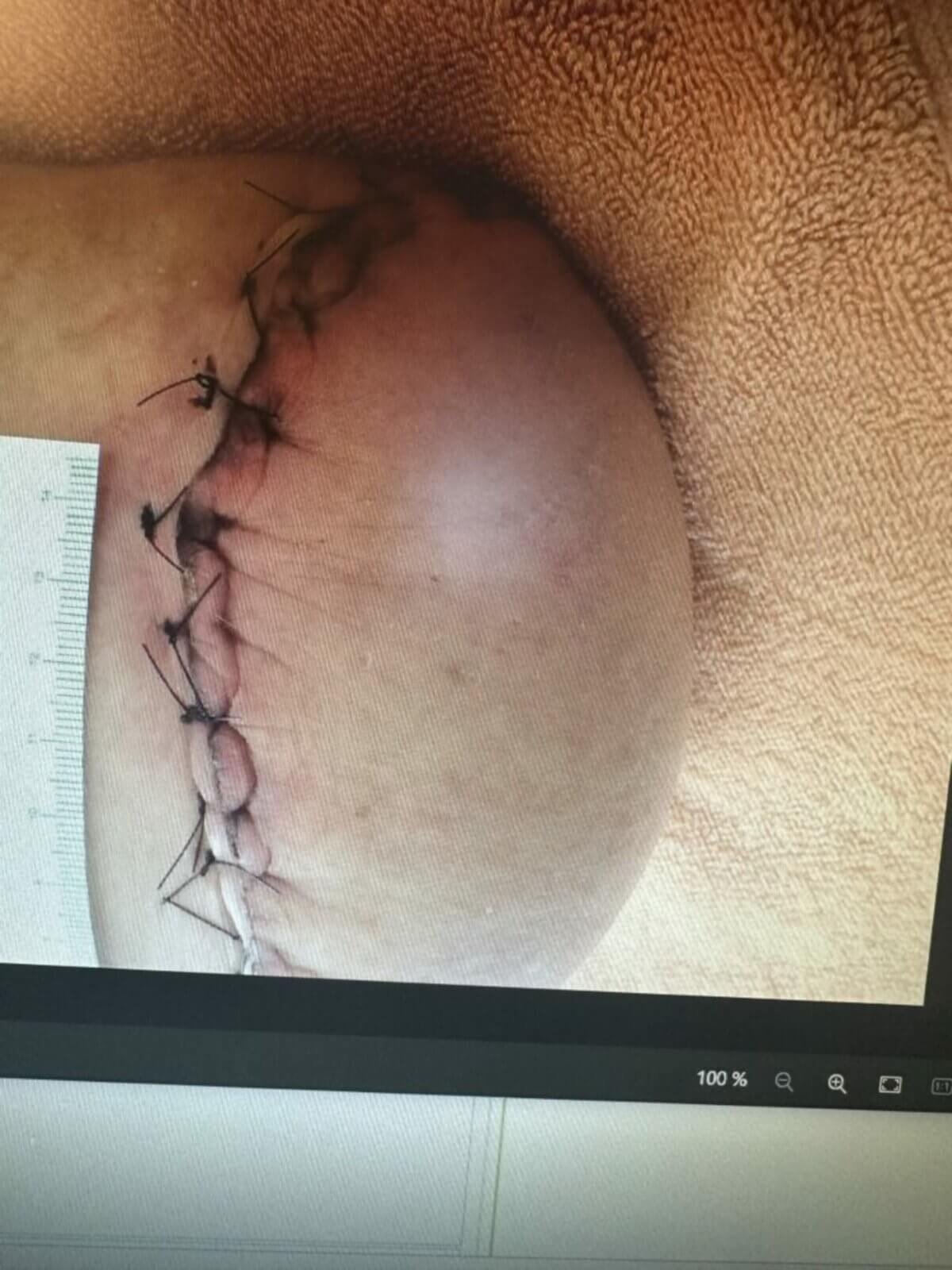 Beinstumpf nach Amputation des Unterschenkels mit frischen Nähten