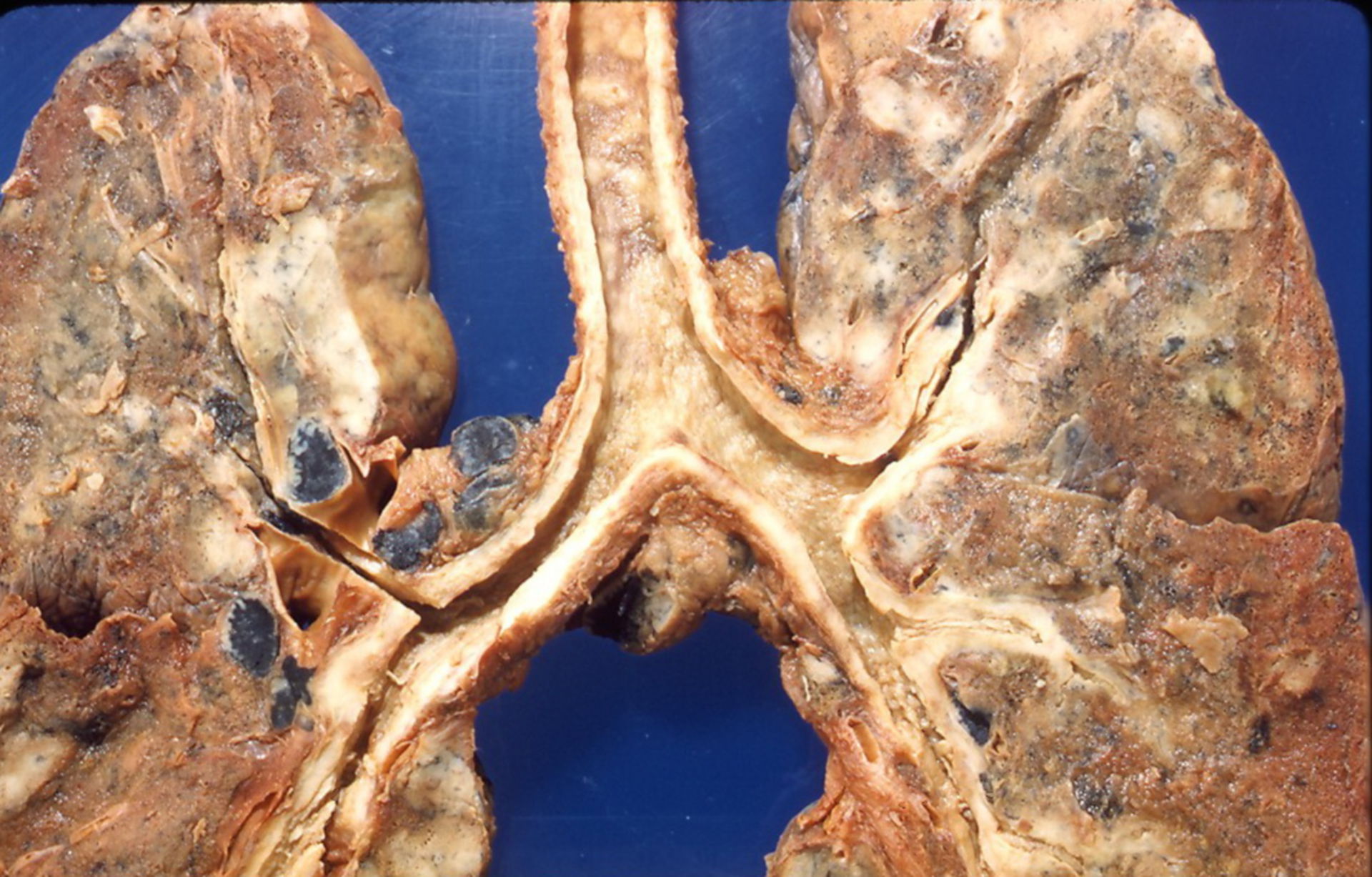 Linfoma No-Hodgkin (pulmón)