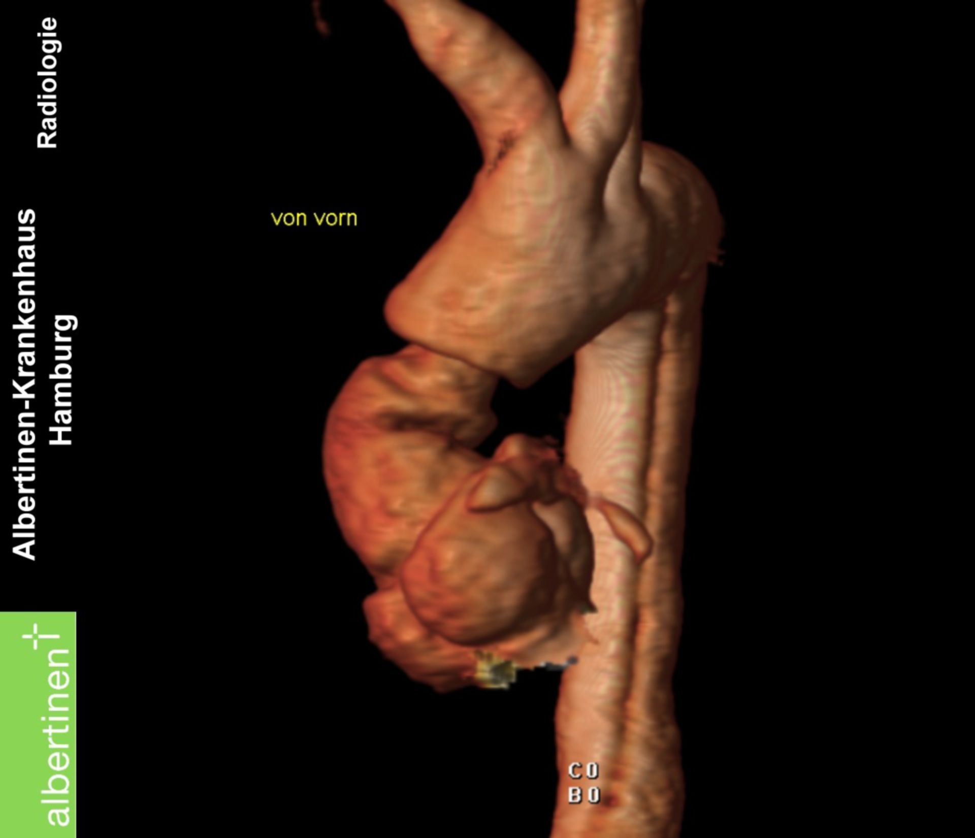 Tomografia a risonanza magnetica - dissecazione aortica