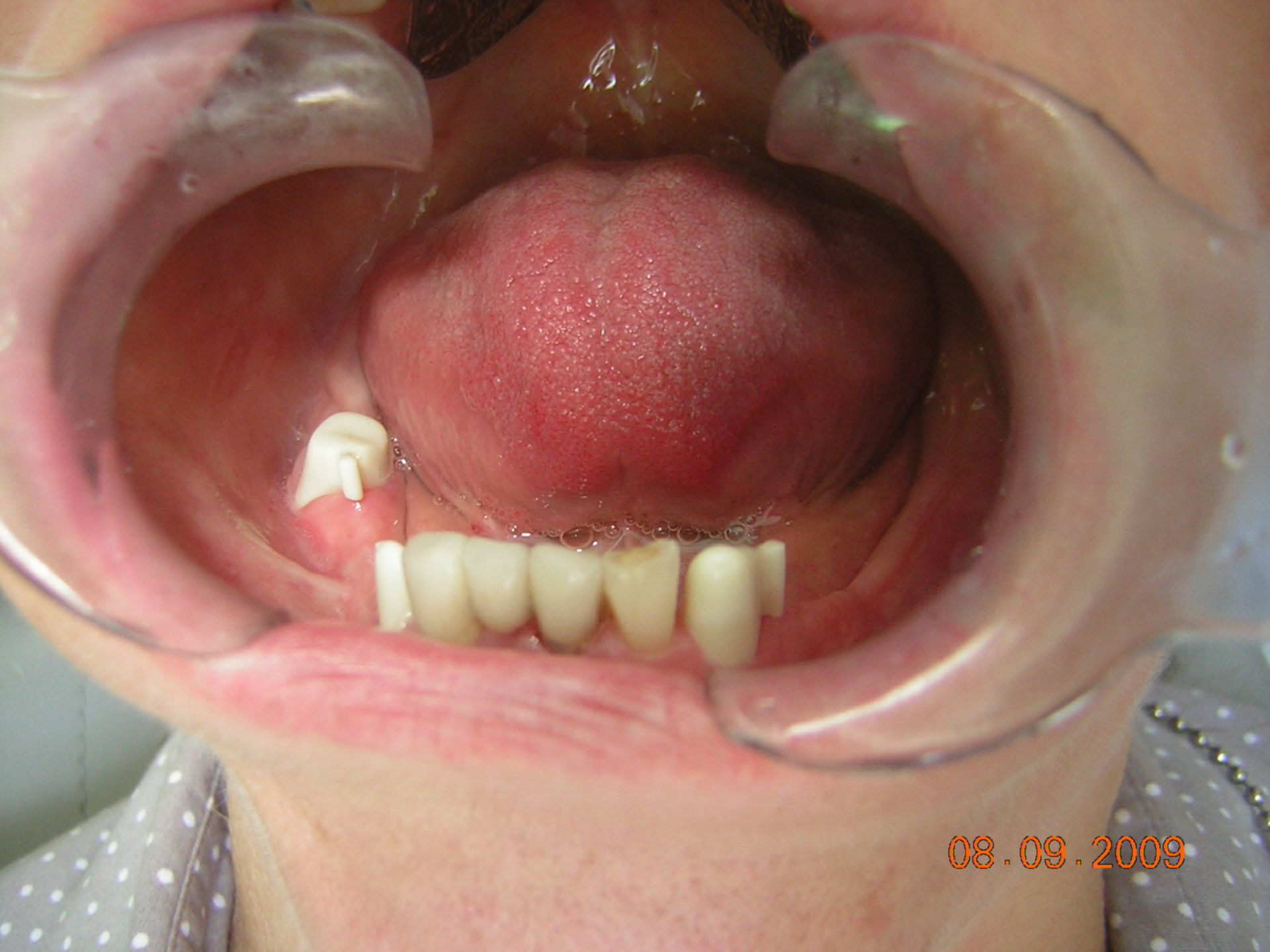 Condizioni dopo protesi dentarie
