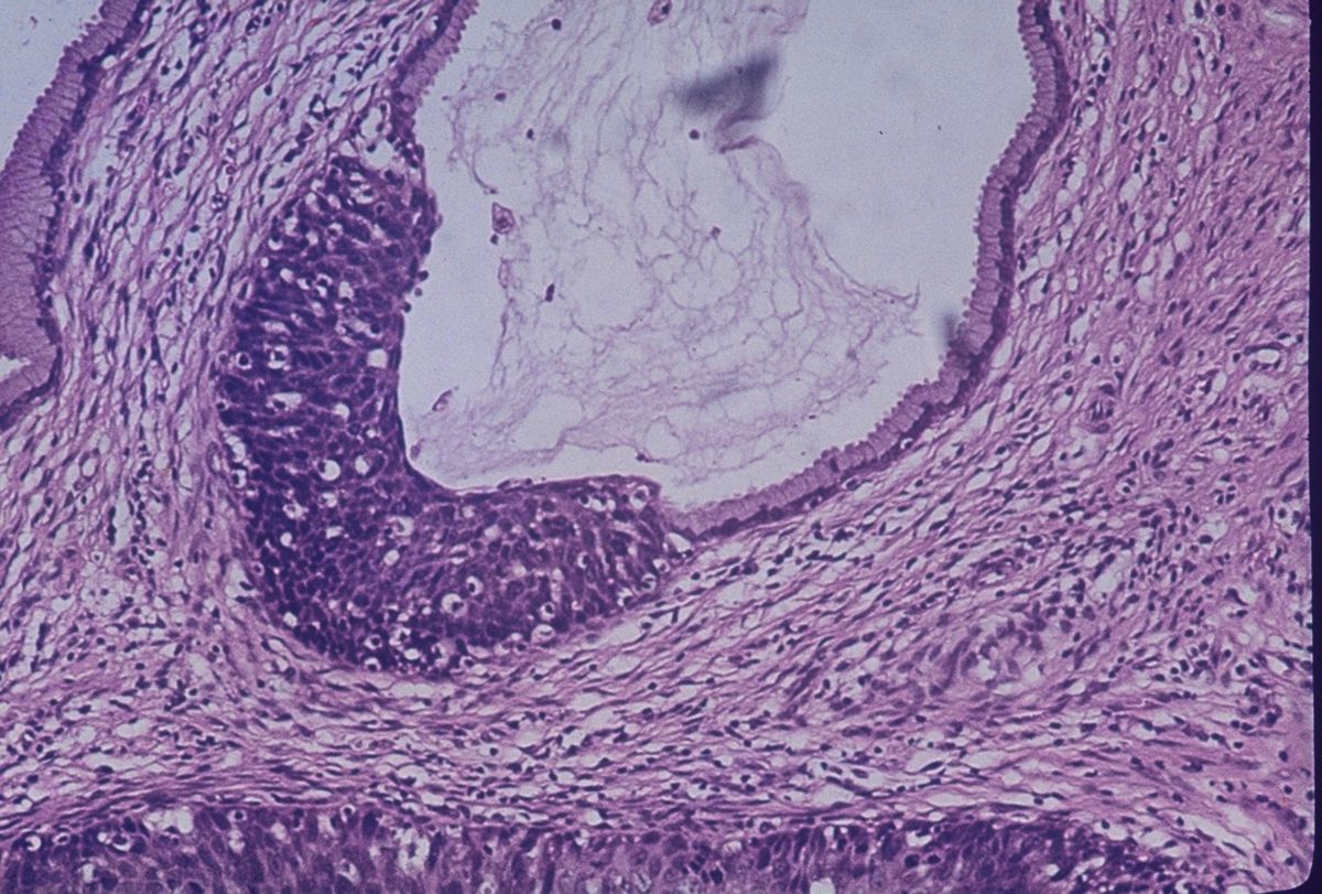 Zervix - Carcinoma in situ (Histologie)