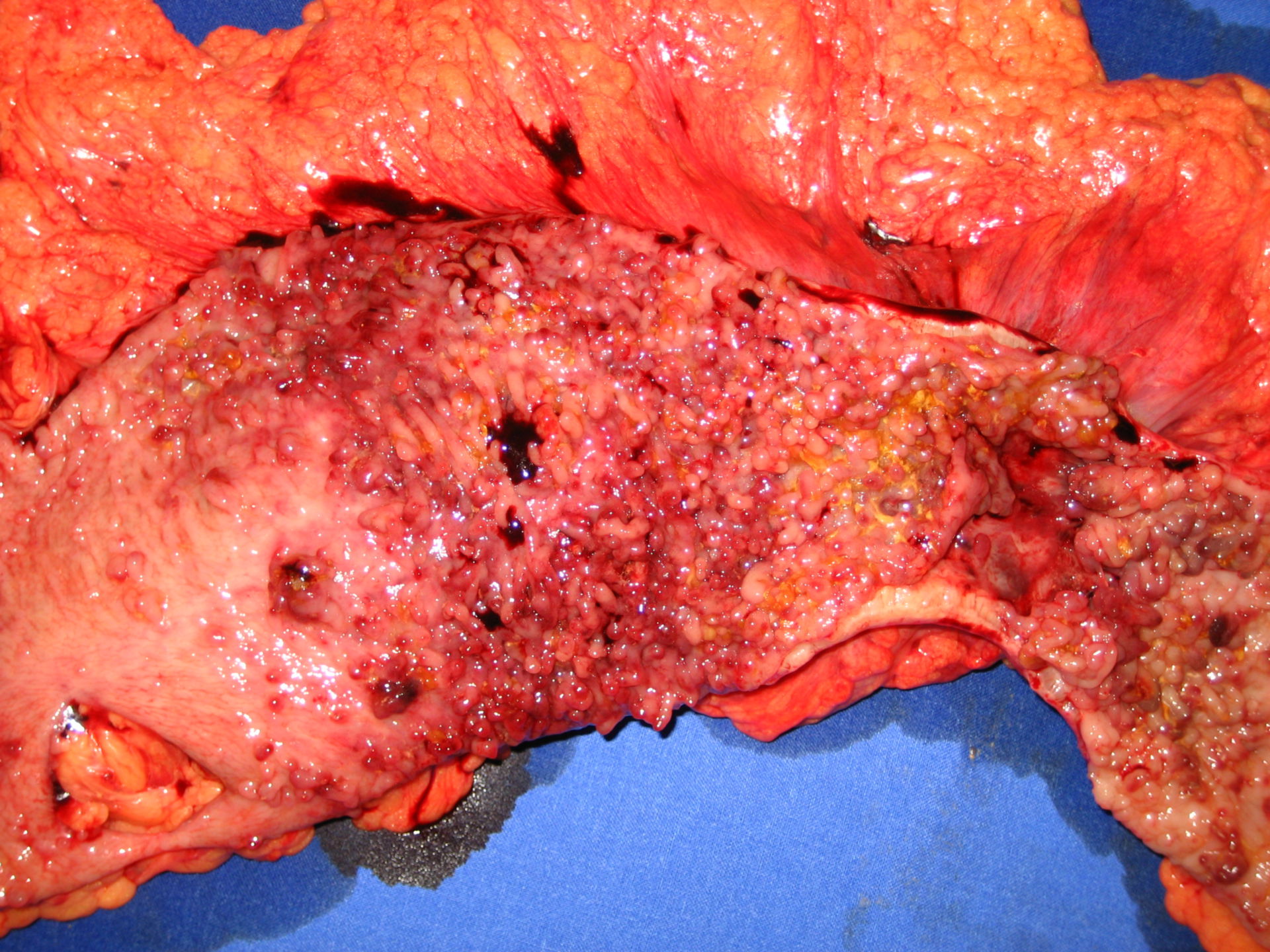 Crohn's disease - large intestines