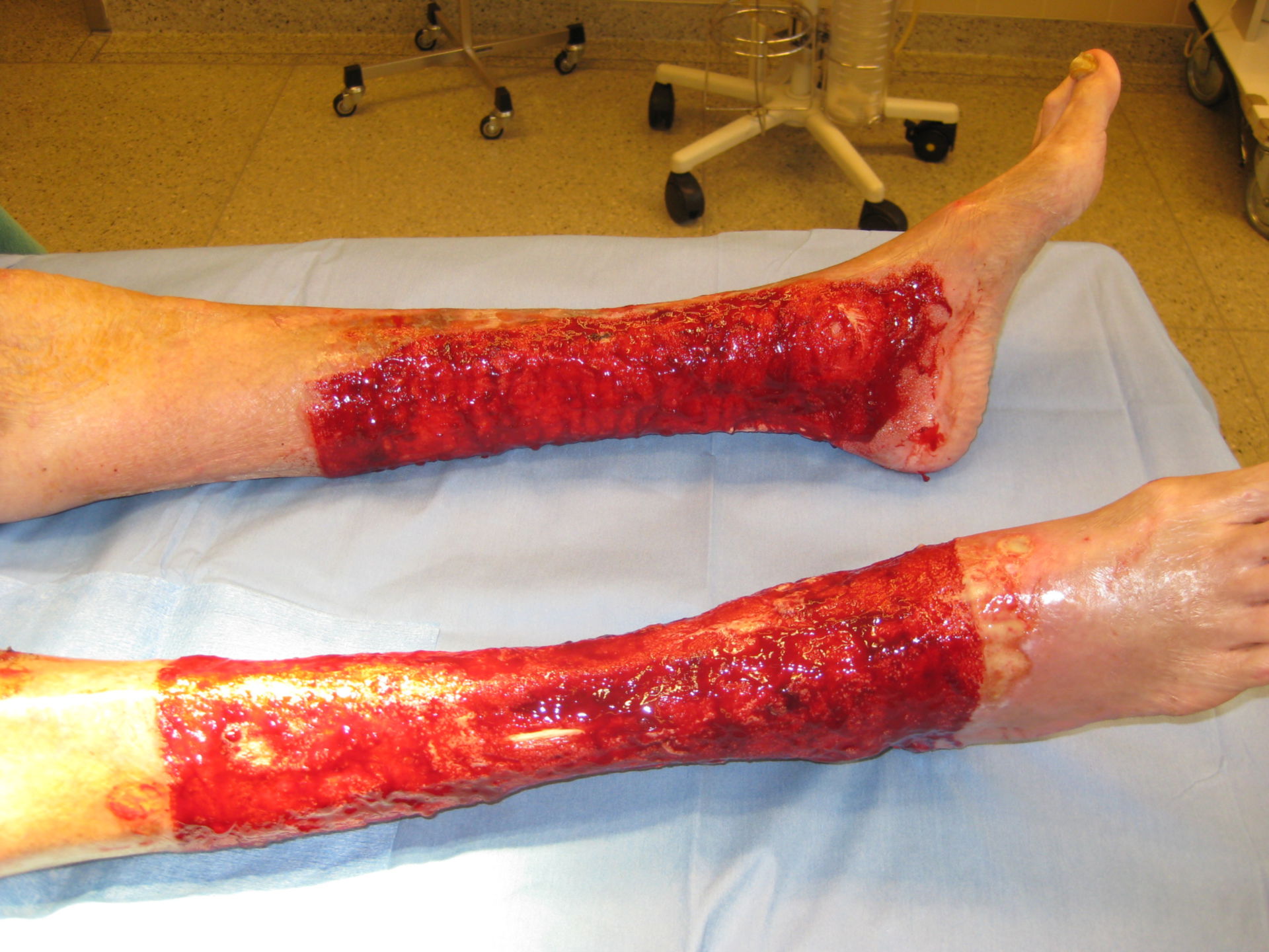 Venous ulcers (both legs)