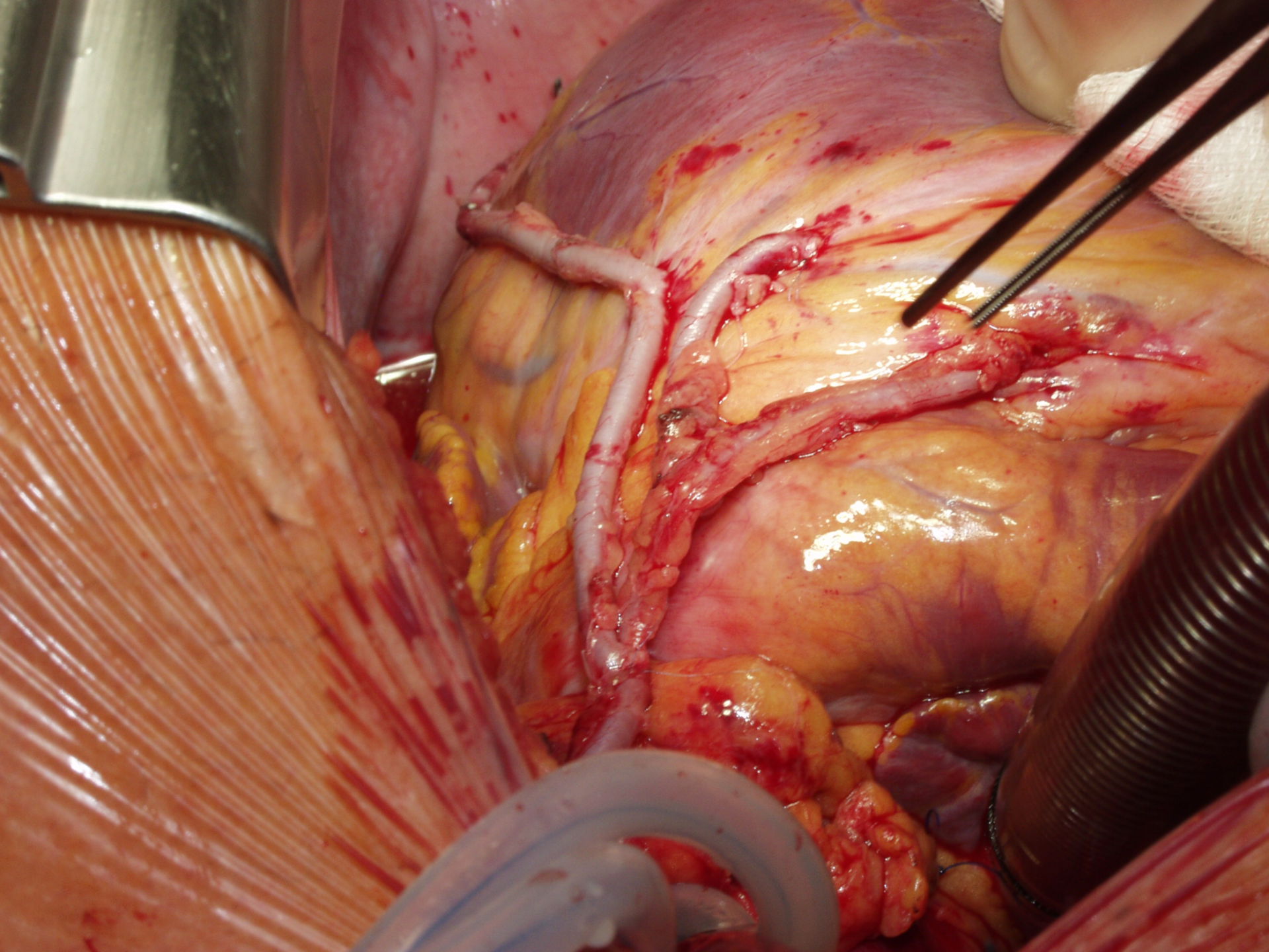 Bypass-OP mit totaler arterieller Revaskularisation (Abb. 2c)