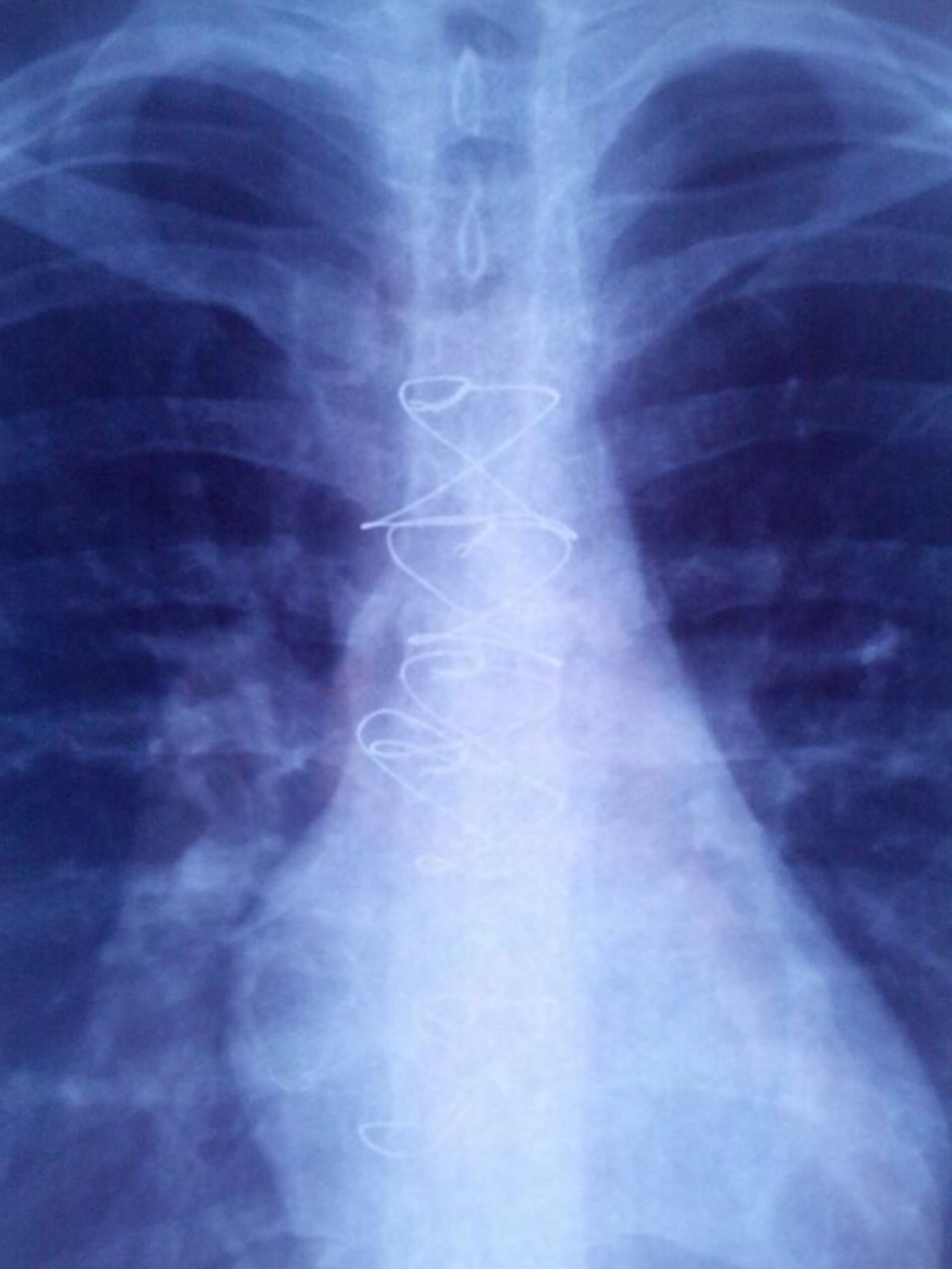 Brustbein Röntgenbild 5 Jahre nach der Operation
