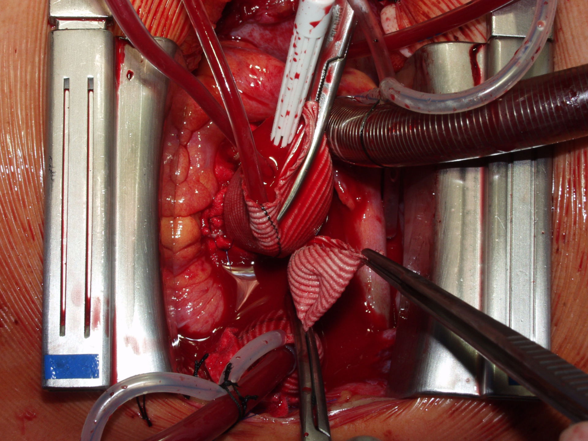Ascending aortic aneurysm (picture 1c)