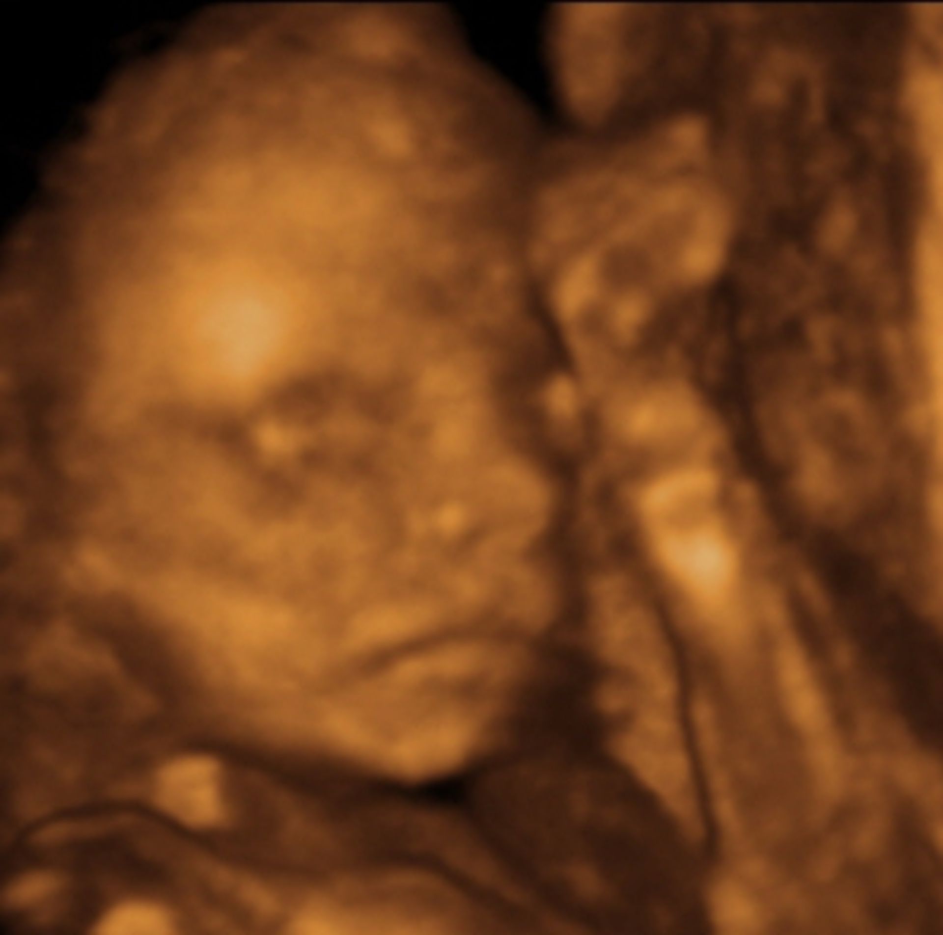 3D-ultrasound, 21 weeks pregnant