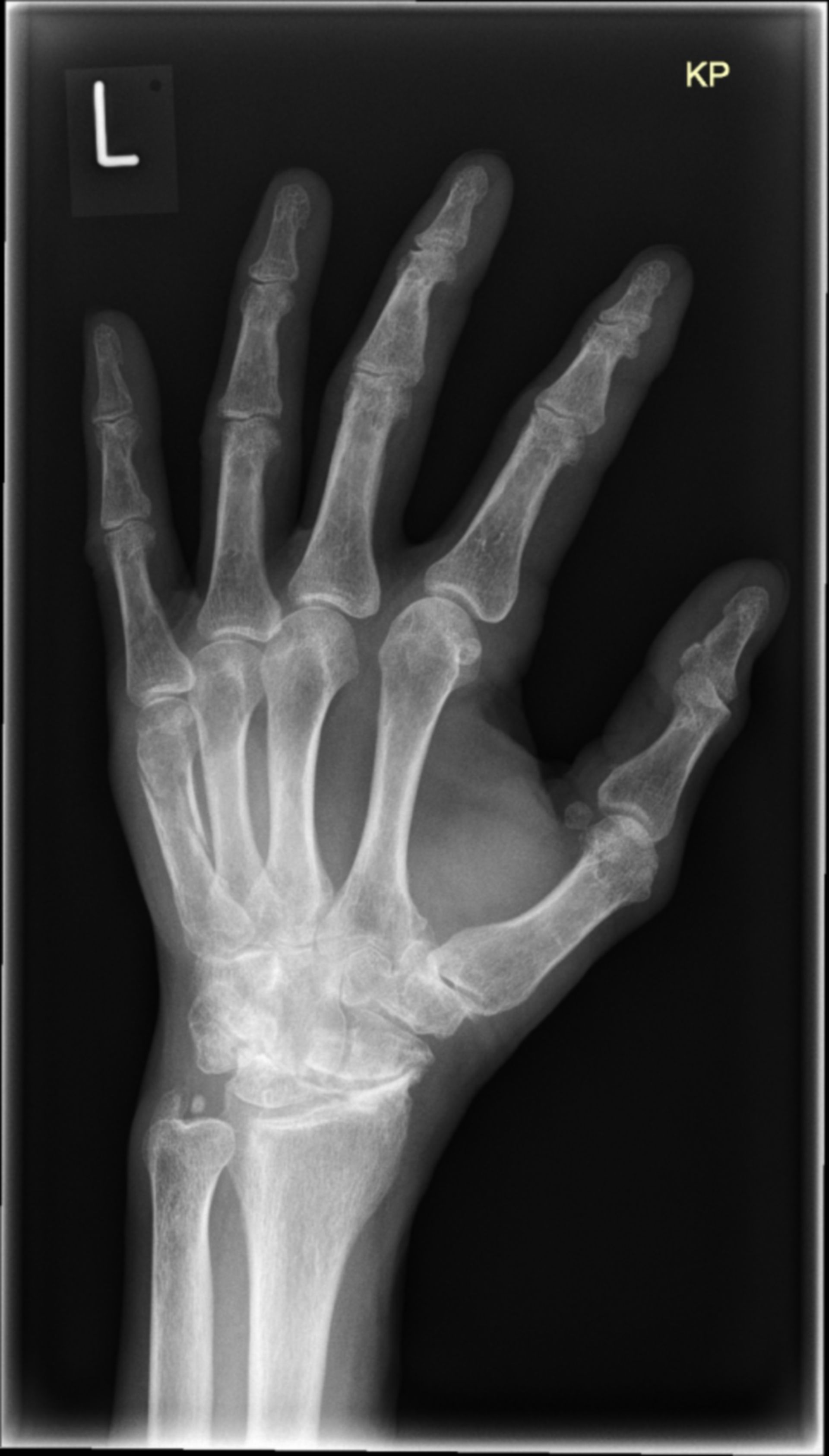 Deformierende Arthrose der Handwurzelknochen (rö_schräg)