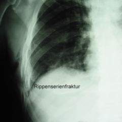 Rippenserienfraktur - DocCheck Flexikon