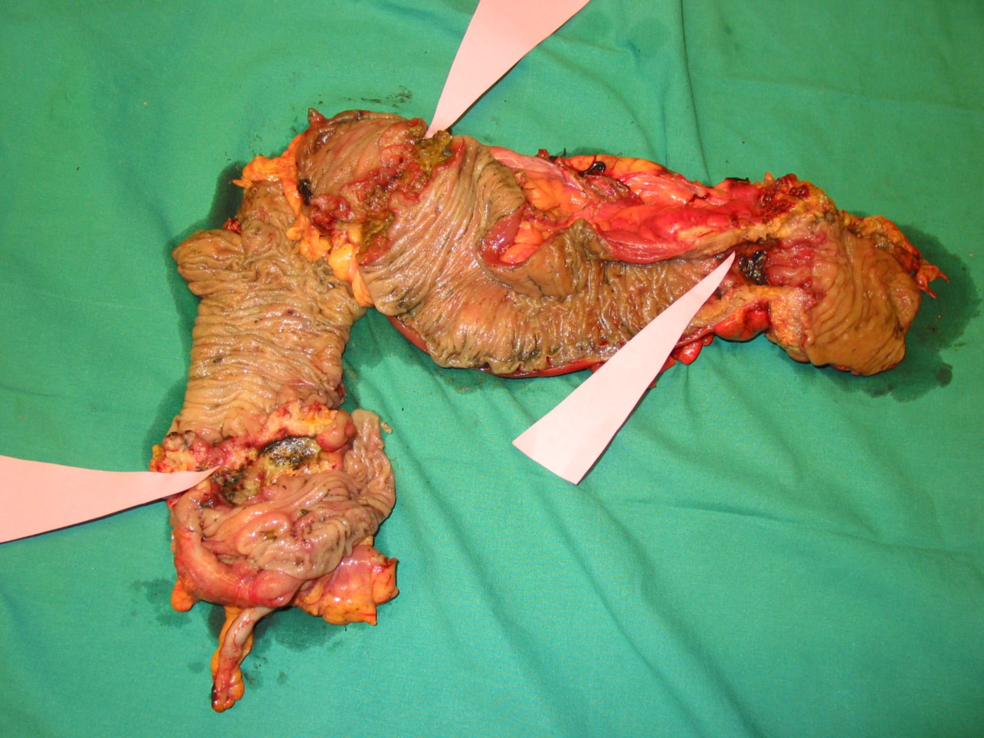 3 colon carcinomas at once in a 71 y.o. patient