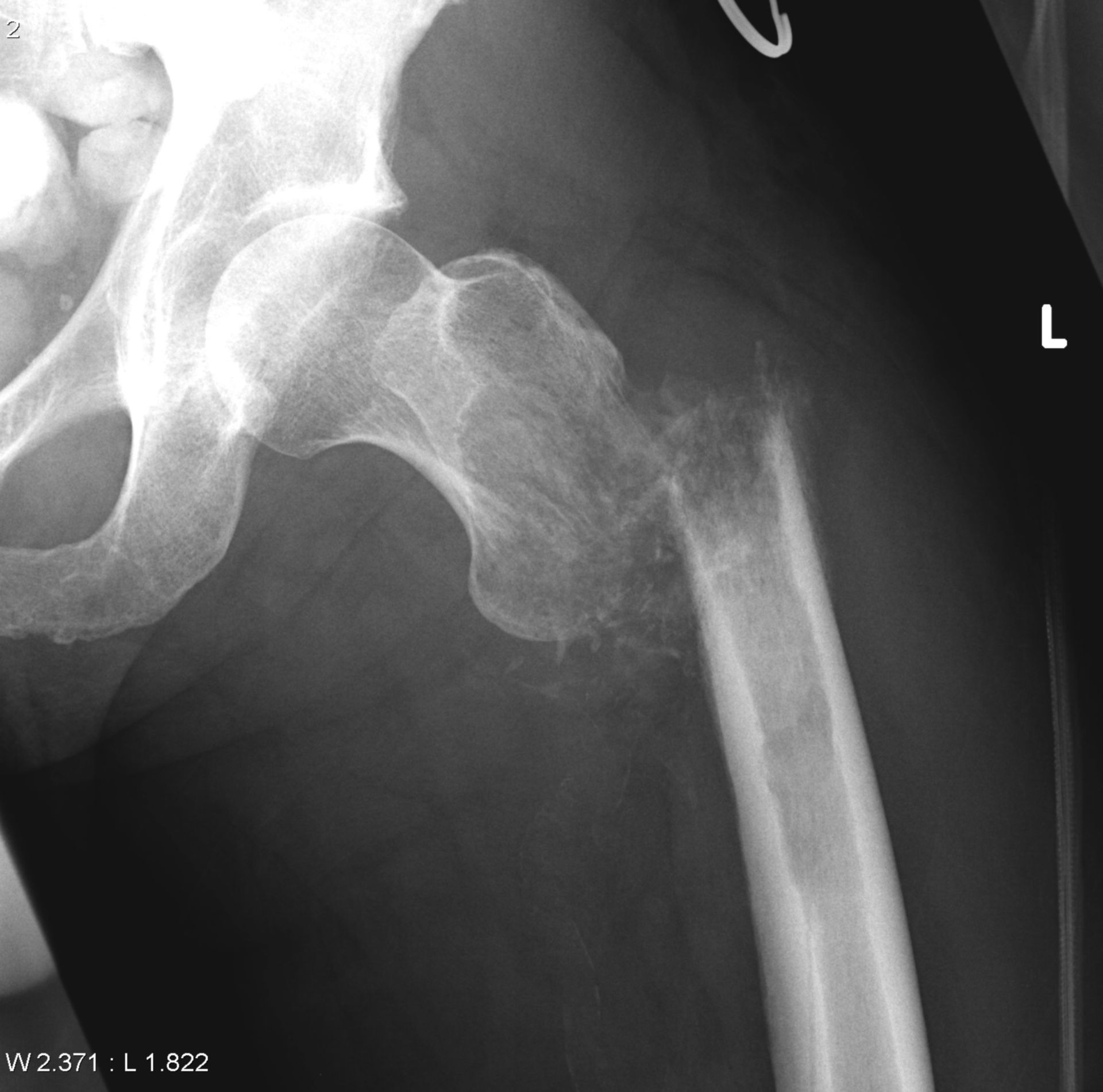 dedifferentiated chondrosarcoma and pathological fracture
