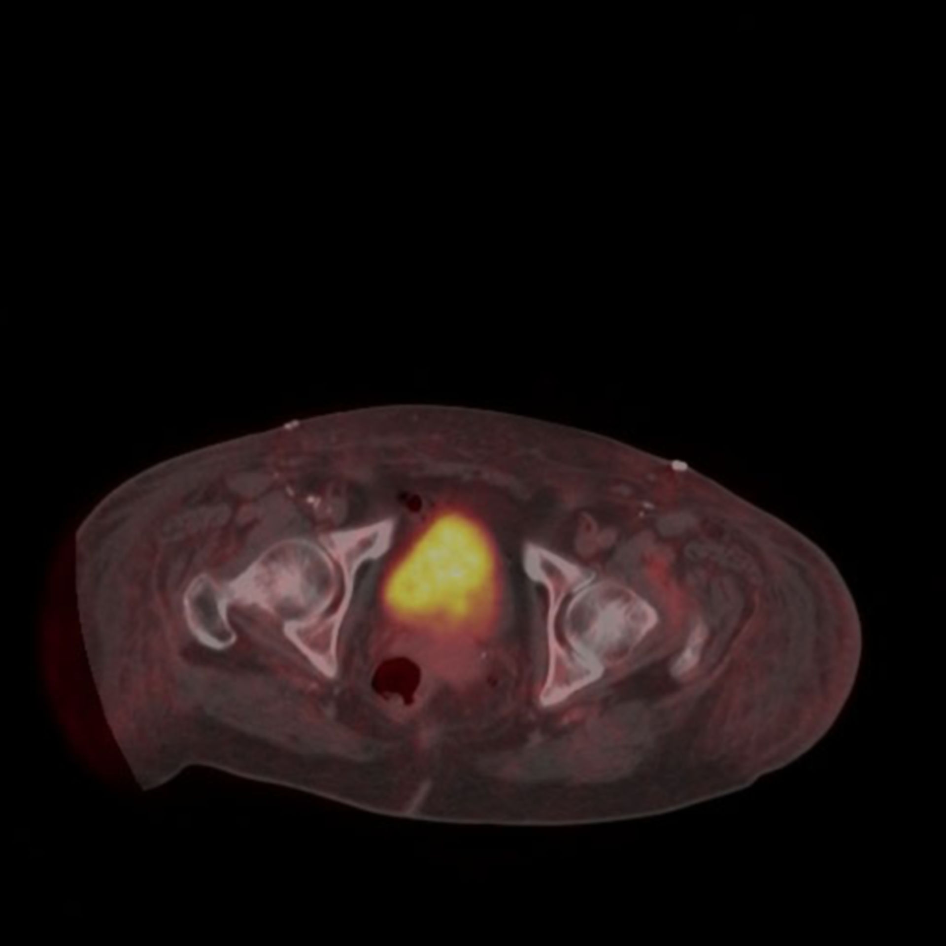 PET scan bladder