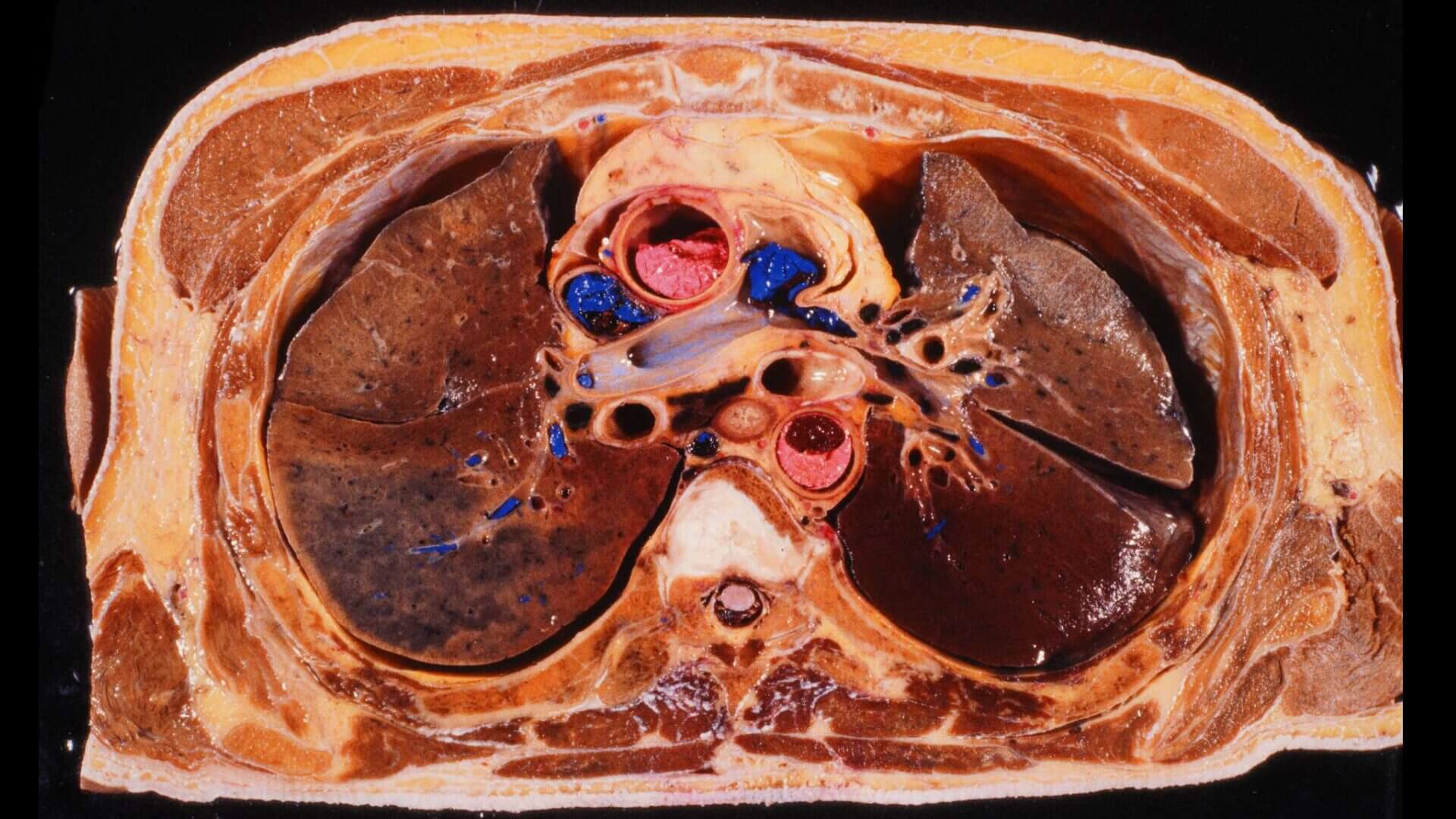 Transversalschnitt Thorax Höhe des Truncus pulmonalis