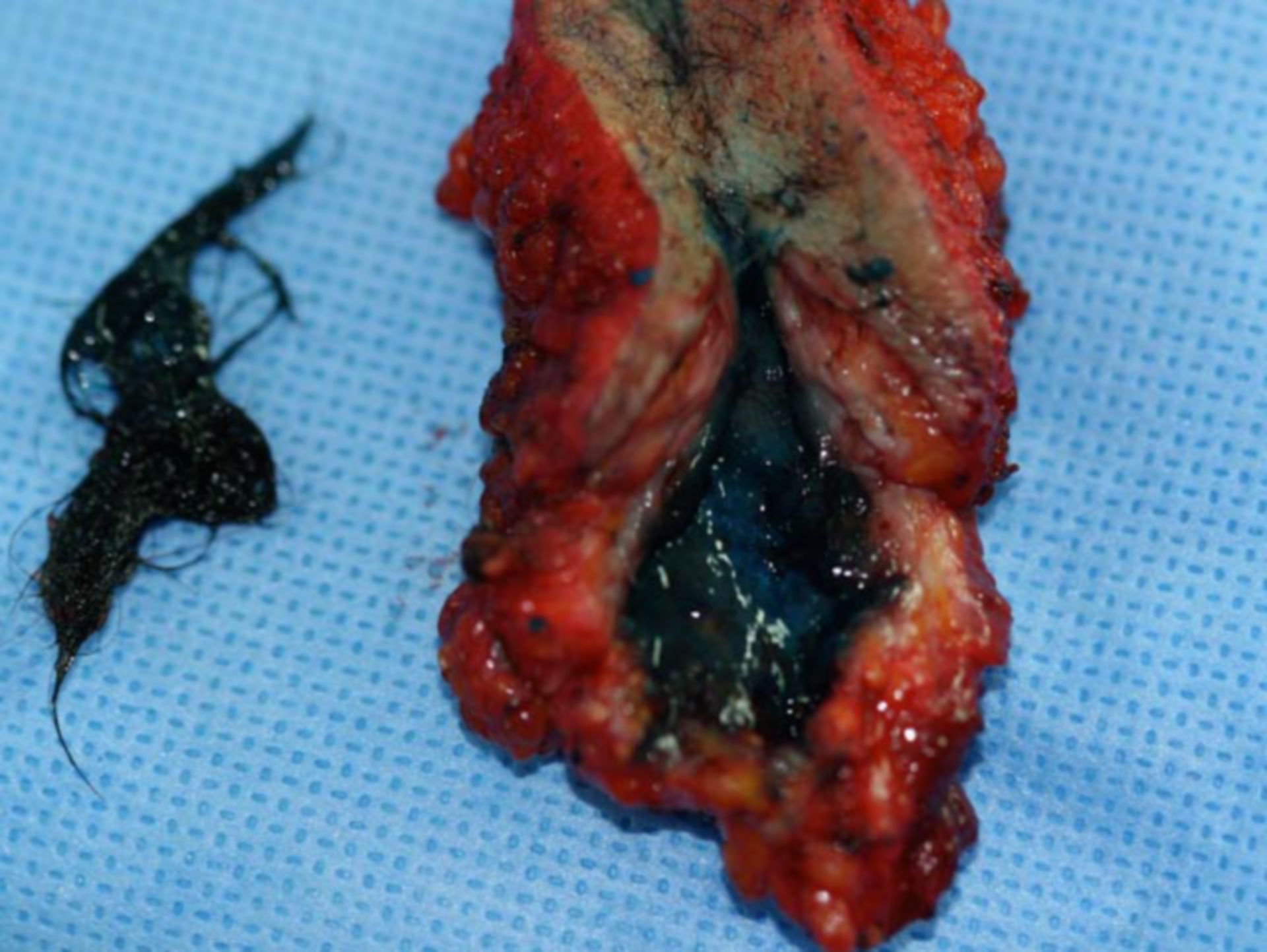 Excision preparation after a coccygeal fistula