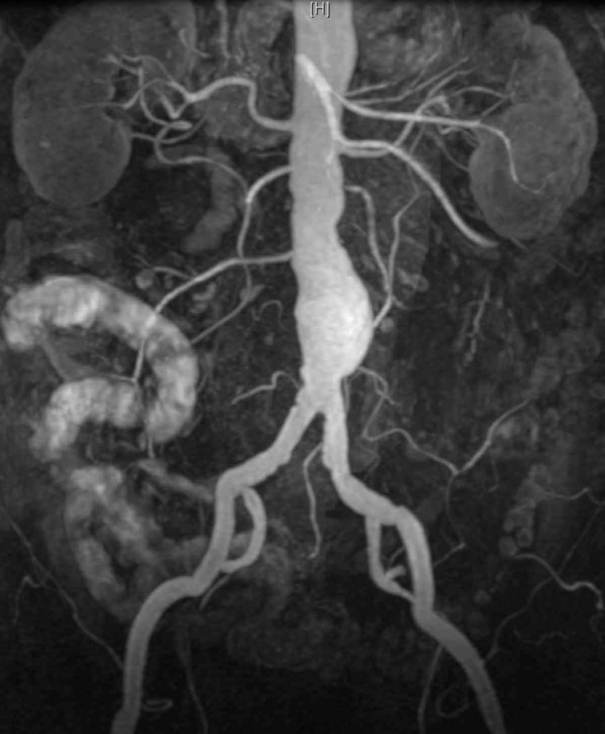 Aneurysma der Aorta abdominalis (MRT)