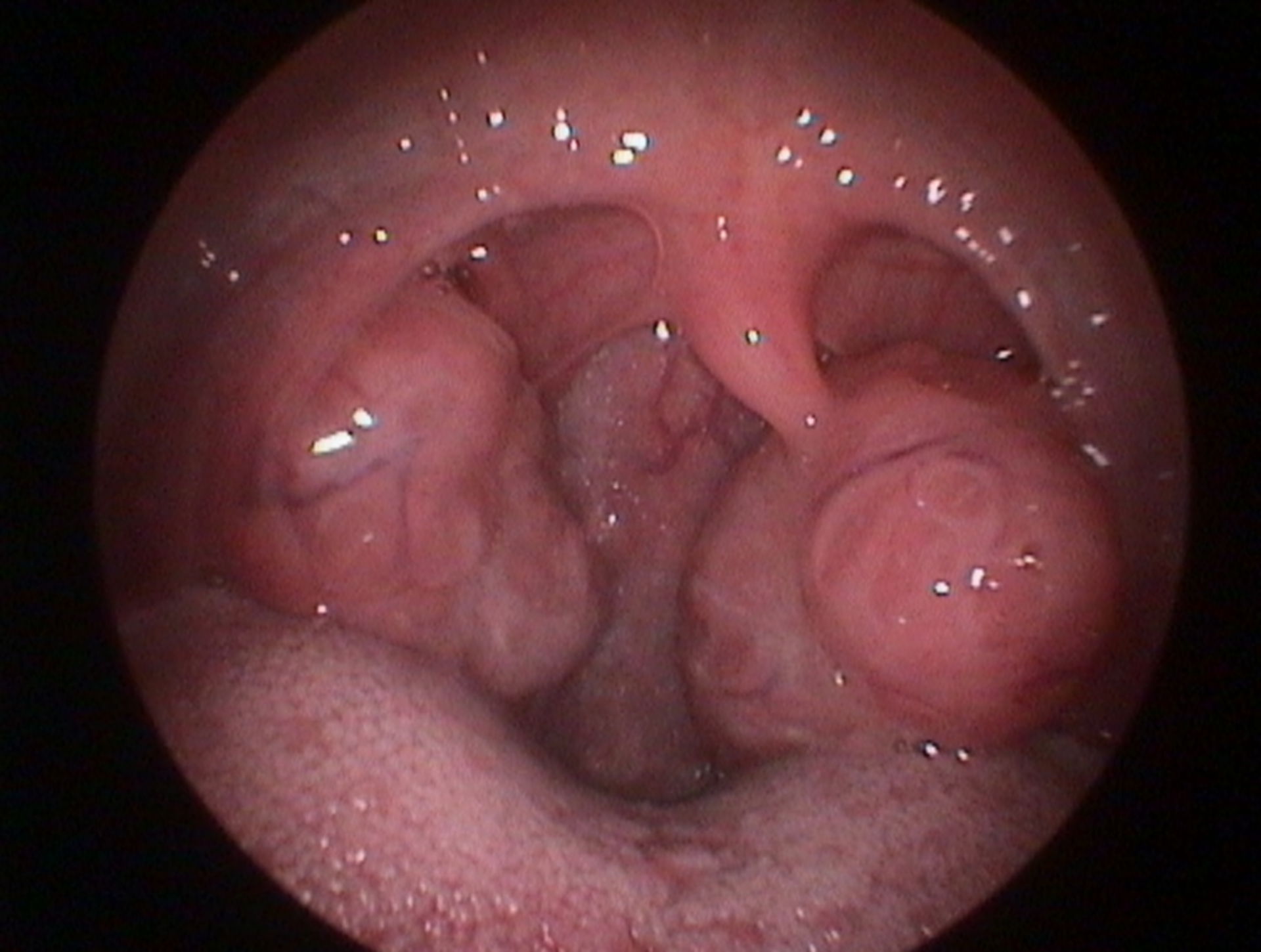 Enlarged neck tonsils