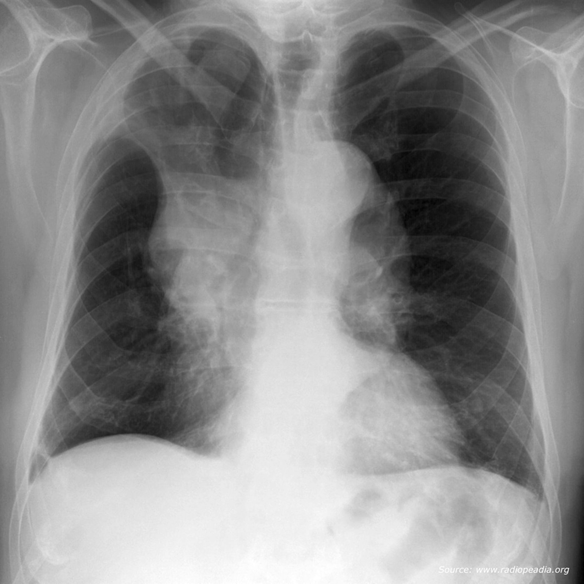 Röntgen-Thorax p-a (Bildrätsel)