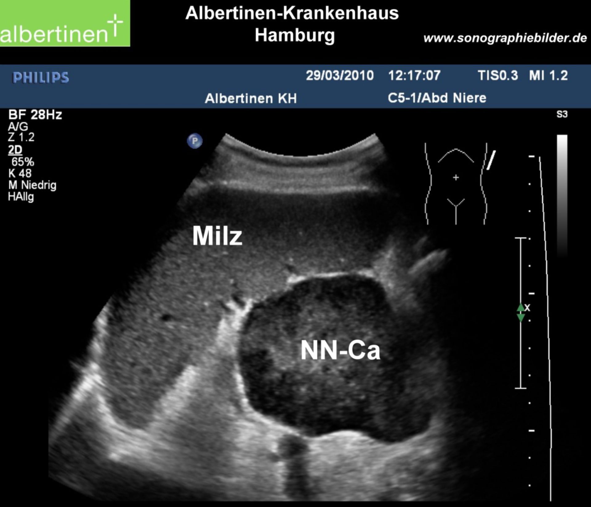 Metastasis of a bronchial carcinoma in the adrenal gland