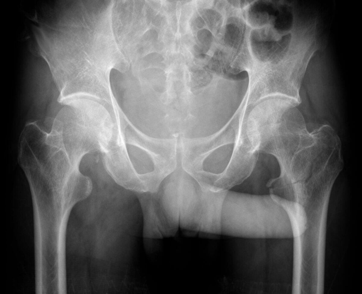 Throckmorton-Zeichen