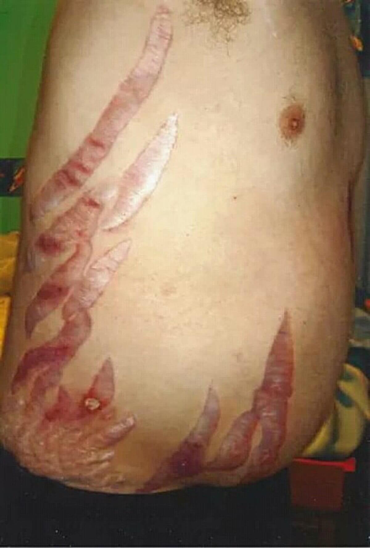 Striae cutis distensae bei Cushing-Syndrom