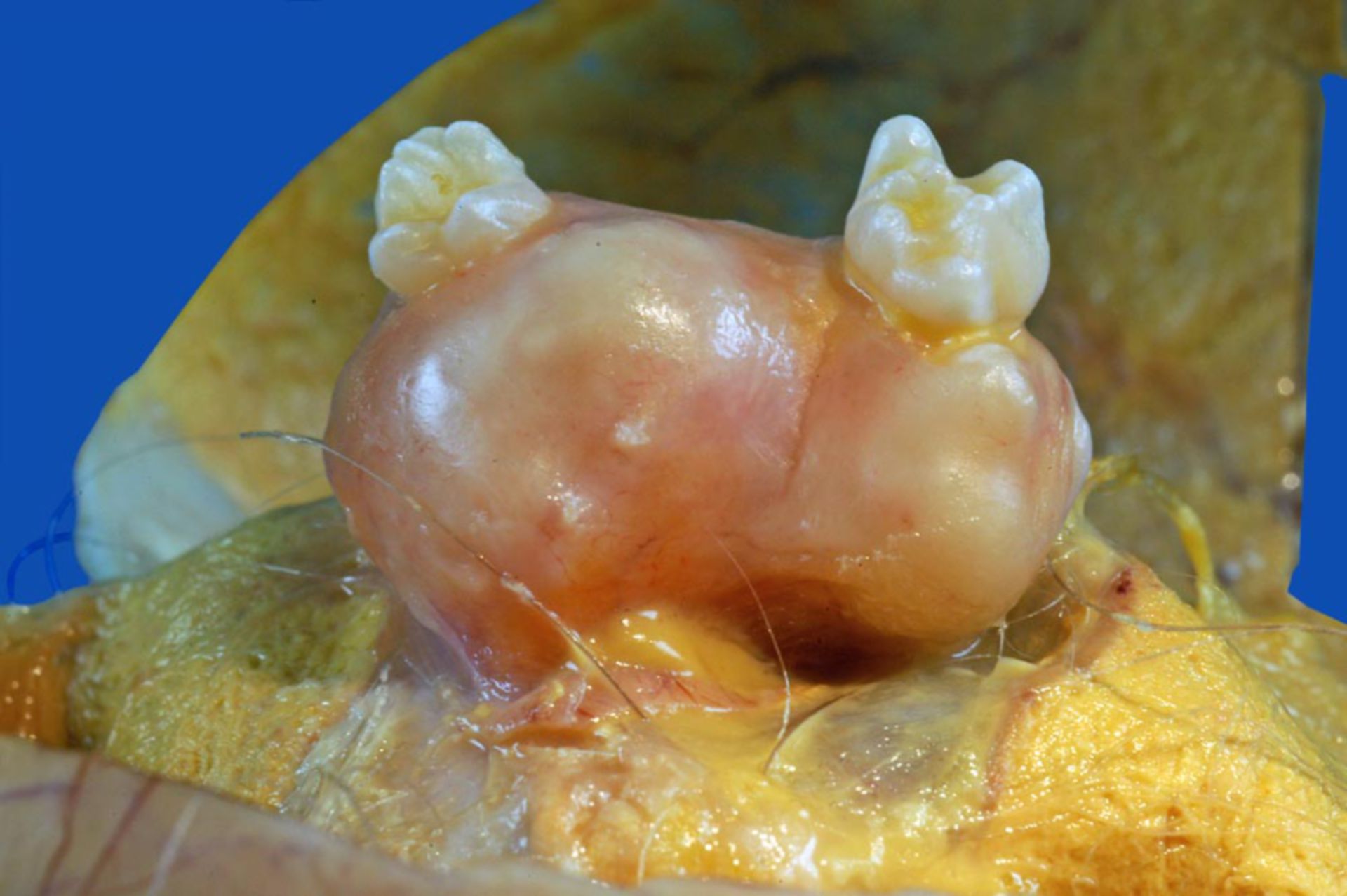Benign mature teratoma of the ovary (2)