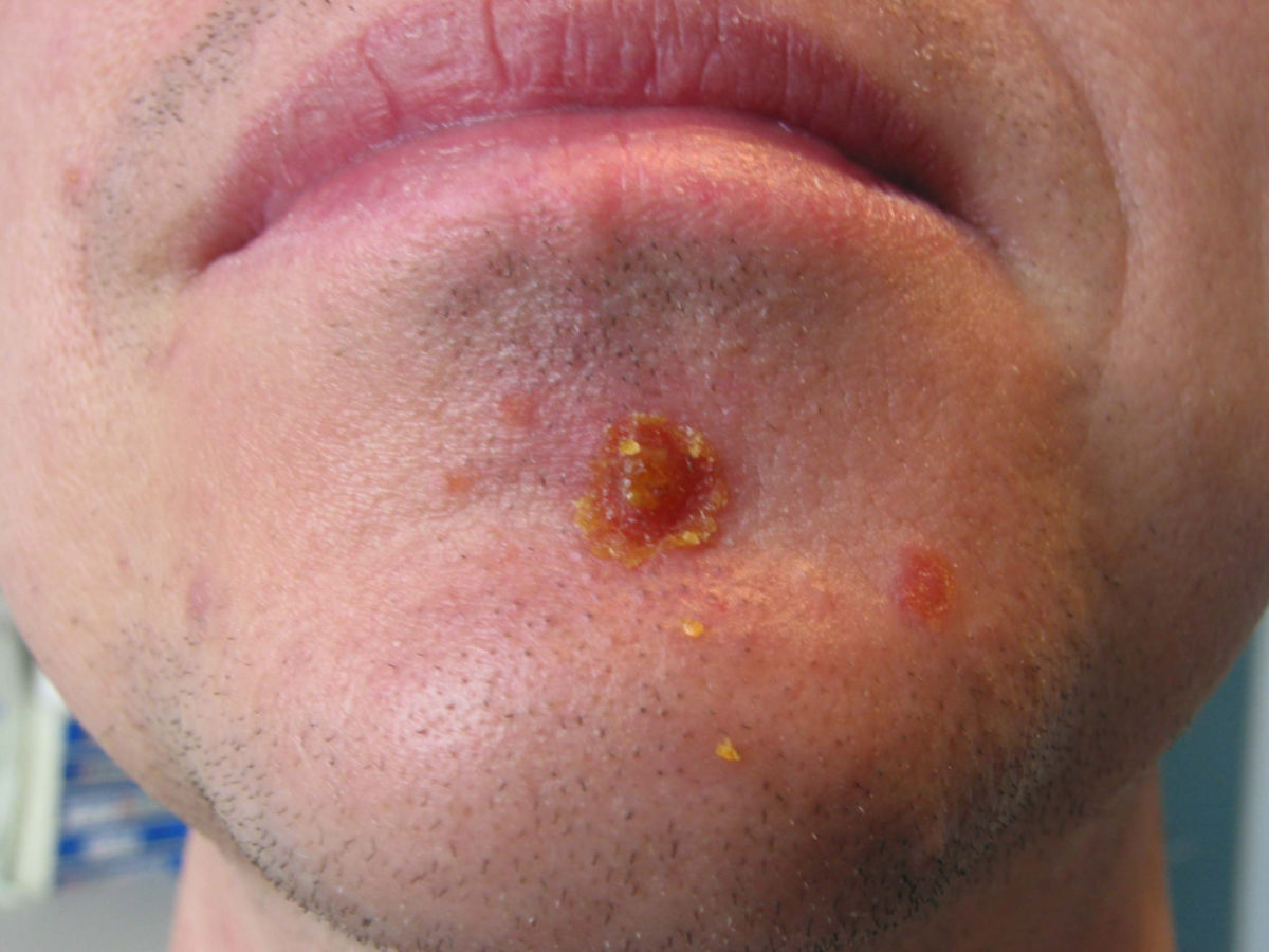 Impetigo contagiosa